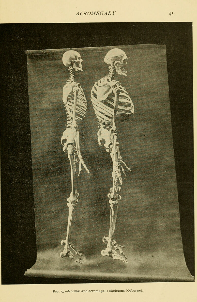 Fig. 23.—Normal and acromegalic skeletons (Osborne).