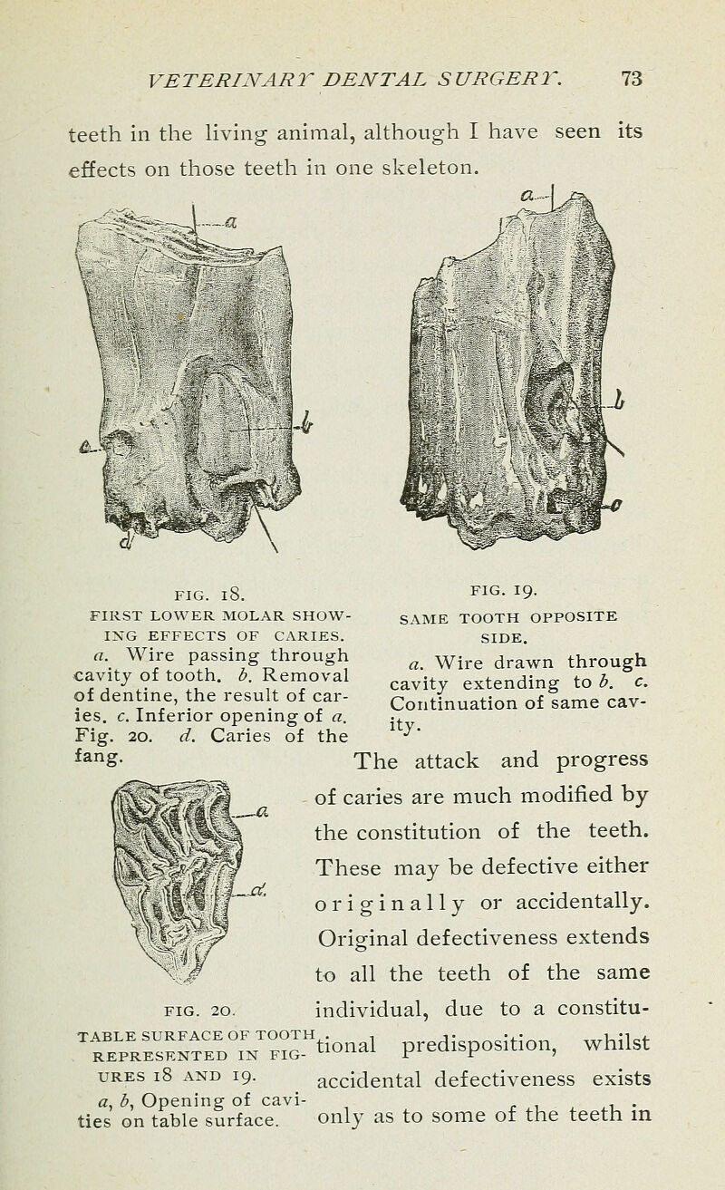 teeth in the living animal, although I have seen its effects on those teeth in one skeleton. ^Stei FIG. l8. FIRST LOWER MOLAR SHOW- ING EFFECTS OF CARIES. a. Wire passing through cavity of tooth, b. Removal of dentine, the result of car- ies, c. Inferior opening of a. Fig. 20. d. Caries of the fang. FIG. 19. SAME TOOTH OPPOSITE SIDE. a. Wire drawn through cavity extending to b. c. Continuation of same cav- ity. The attack and progress of cai-ies are much modified by the constitution of the teeth. These may be defective either originally or accidentally. Original defectiveness extends to all the teeth of the same fig. 20. individual, due to a constitu- nSSSEJS-^ttond predisposition, whilst ures 18 and 19. accidental defectiveness exists «, b, Opening of cavi- .i_ • ties on table surface. only as to some ot the teeth in