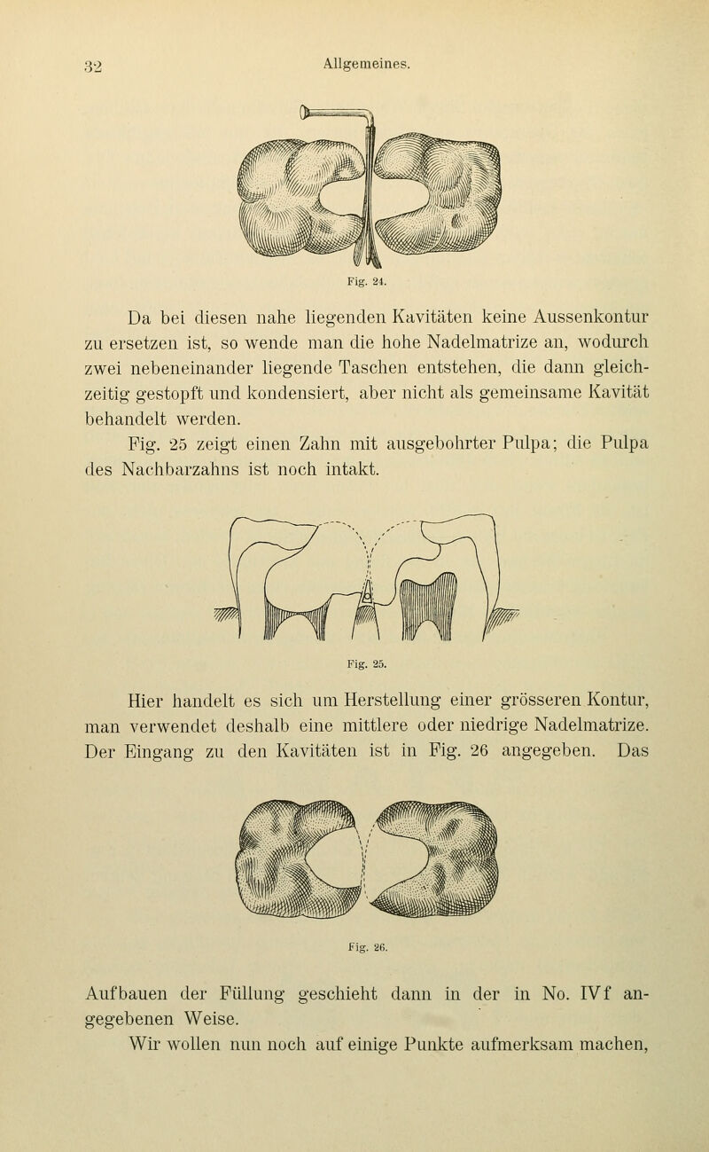 Fig. 24. Da bei diesen nahe liegenden Kavitäten keine Aussenkontur zu ersetzen ist, so wende man die liohe Nadelmatrize an, wodurch zwei nebeneinander liegende Taschen entstehen, die dann gleich- zeitig gestopft und kondensiert, aber nicht als gemeinsame Kavität behandelt werden. Fig. 25 zeigt einen Zahn mit ausgebolirter Pulpa; die Pulpa des Nachbarzahns ist noch intakt. Fig. 25. Hier handelt es sich um Herstellung einer grösseren Kontur, man verwendet deshalb eine mittlere oder niedrige Nadelmatrize. Der Eingang zu den Kavitäten ist in Fig. 26 angegeben. Das Fig. 26. Aufbauen der Füllung geschieht dann in der in No. IV f an- gegebenen Weise. Wir wollen nun noch auf einige Punkte aufmerksam machen.