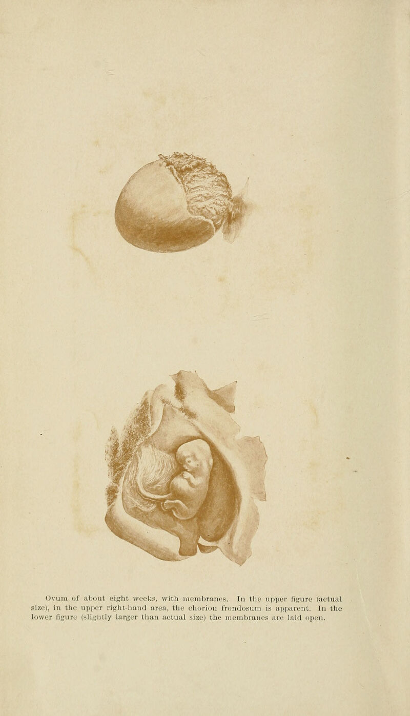 Ovum of about eight weeks, with membranes. In the upper figure (actual size), in the upper right-hand area, the chorion frondosum is apparent. In tlie lower figure (slightly larger than actual size) the membranes are laid ojjcn.