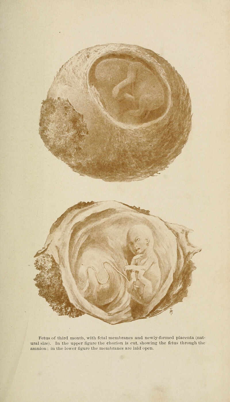 Fetus of third month, with fetal membranes and newly-formed placenta (nat- ural size). In the upper figure the chorion is cut, showing the fetus through the amnion; in the lower figure the membranes are laid open.