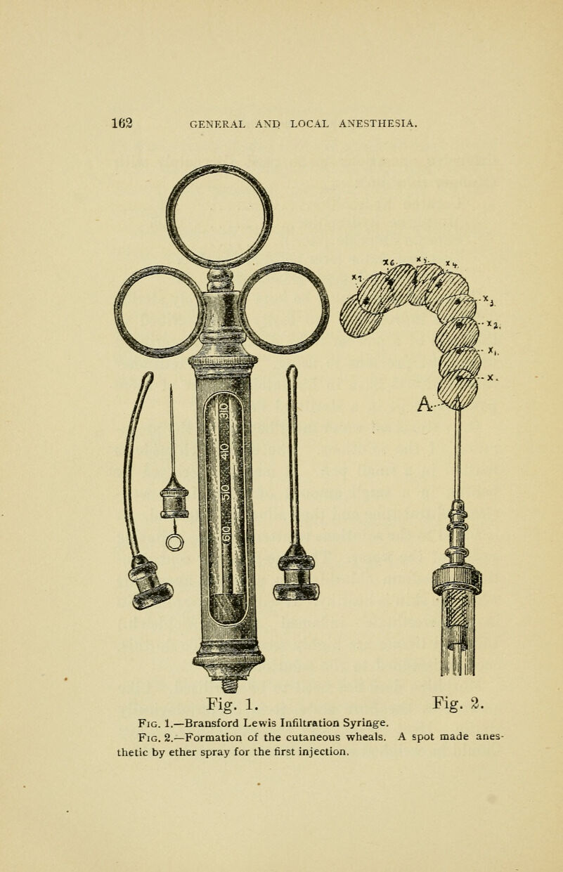 Fig. 1. Fig. 2. Fig. 1.—Bransford Lewis Infiltration Syringe. Fig. 2.—Formation of the cutaneous wheals. A spot made anes- thetic by ether spray for the first injection.