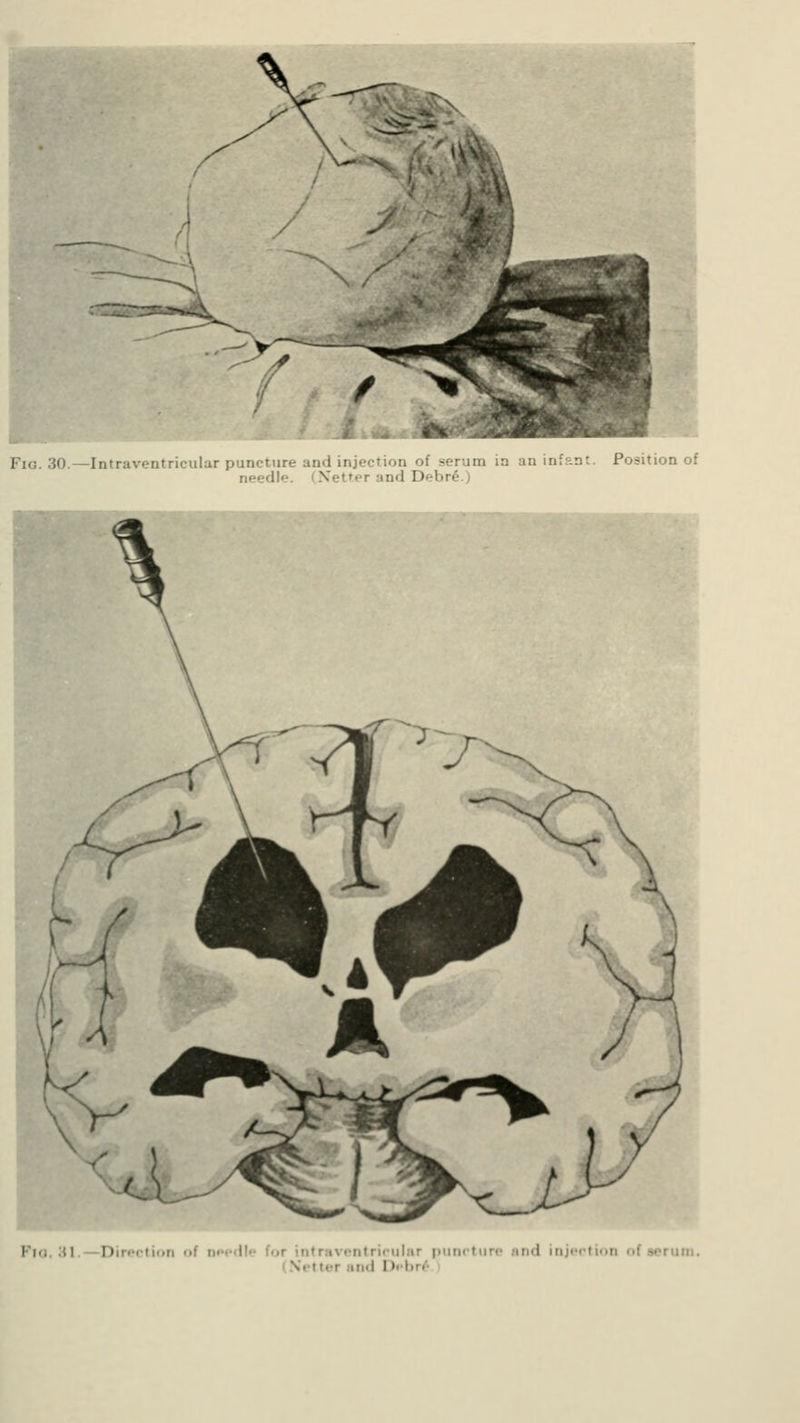 Fig. 30.—Intraventricular puncture- and injection of needle. Netter and Debrfi Fig ;i -Direction of a lie for intraventricular puncture ;itm1 injection of serum, ■ tei iri.l Deb