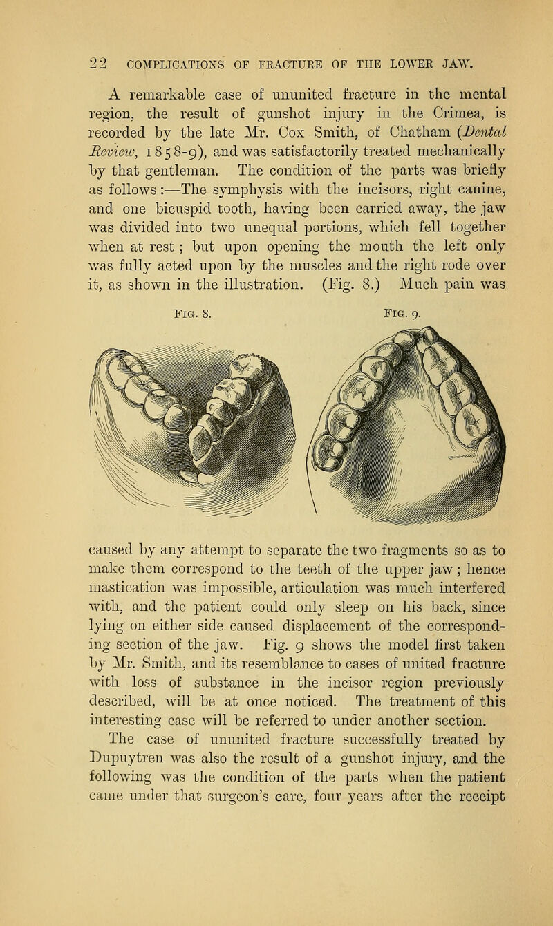 A remarkable case of ununited fracture in the mental region, the result of gunshot injury in the Crimea, is recorded by the late Mr. Cox Smith, of Chatham {Dental Review, 185 8-9), and was satisfactorily treated mechanically by that gentleman. The condition of the parts was briefly as follows:—The symphysis with the incisors, right canine, and one bicuspid tooth, having been carried away, the jaw was divided into two unequal portions, which fell together when at rest; but upon opening the mouth the left only was fully acted upon by the muscles and the right rode over it, as shown in the illustration. (Fig. 8.) Much pain was Fig. 8. Fig. 9. caused by any attempt to separate the two fragments so as to make them correspond to the teeth of the upper jaw; hence mastication was impossible, articulation was much interfered with, and the patient could only sleep on his back, since lying on either side caused displacement of the correspond- ing section of the jaw. Fig. 9 shows the model first taken by Mr. Smith, and its resemblance to cases of united fracture with loss of substance in the incisor region previously described, will be at once noticed. The treatment of this interesting case will be referred to under another section. The case of ununited fracture successfully treated by Dupuytren was also the result of a gunshot injury, and the following was the condition of the parts when the patient came under tliat surgeon's care, four years after the receipt