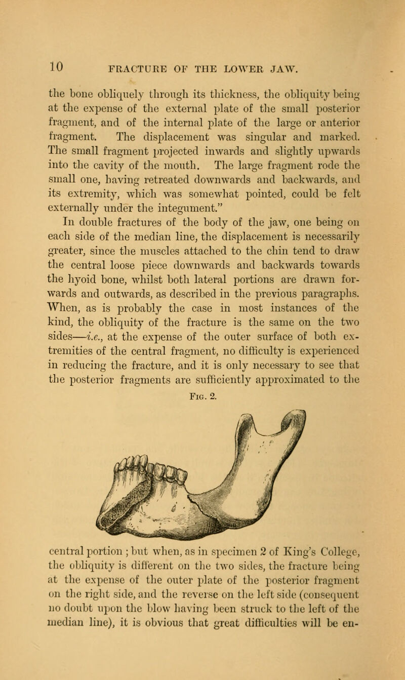 the bone obliquely tlirougli its thickness, the obliquity being at the expense of the external plate of the small posterior fragment, and of the internal plate of the large or anterior fragment. The displacement was singular and marked. The small fragment projected inwards and slightly upwards into the cavity of the mouth. The large fragment rode the small one, having retreated downwards and backwards, and its extremity, which was somewhat pointed, could be felt externally under the integument. In double fractures of the body of the jaw, one being on each side of the median line, the displacement is necessarily greater, since tlie muscles attached to the chin tend to draw the central loose piece downwards and backwards towards the hyoid bone, whilst both lateral portions are drawn for- wards and outwards, as described in the previous paragraplis. When, as is probably the case in most instances of the kind, the obliquity of the fracture is the same on the two sides—i.e., at the expense of the outer surface of both ex- tremities of the central fragment, no difhculty is experienced in reducing the fracture, and it is only necessary to see that the posterior fragments are sufficiently approximated to the Fig. 2. central portion ; but when, as in specimen 2 of King's College, the obliquity is different on tlie two sides, the fracture being at the expense of the outer plate of the posterior fragment on the right side, and the reverse on the left side (consequent no doubt ujjon the blow having been struck to the left of the median line), it is obvious that great difticulties will be en-