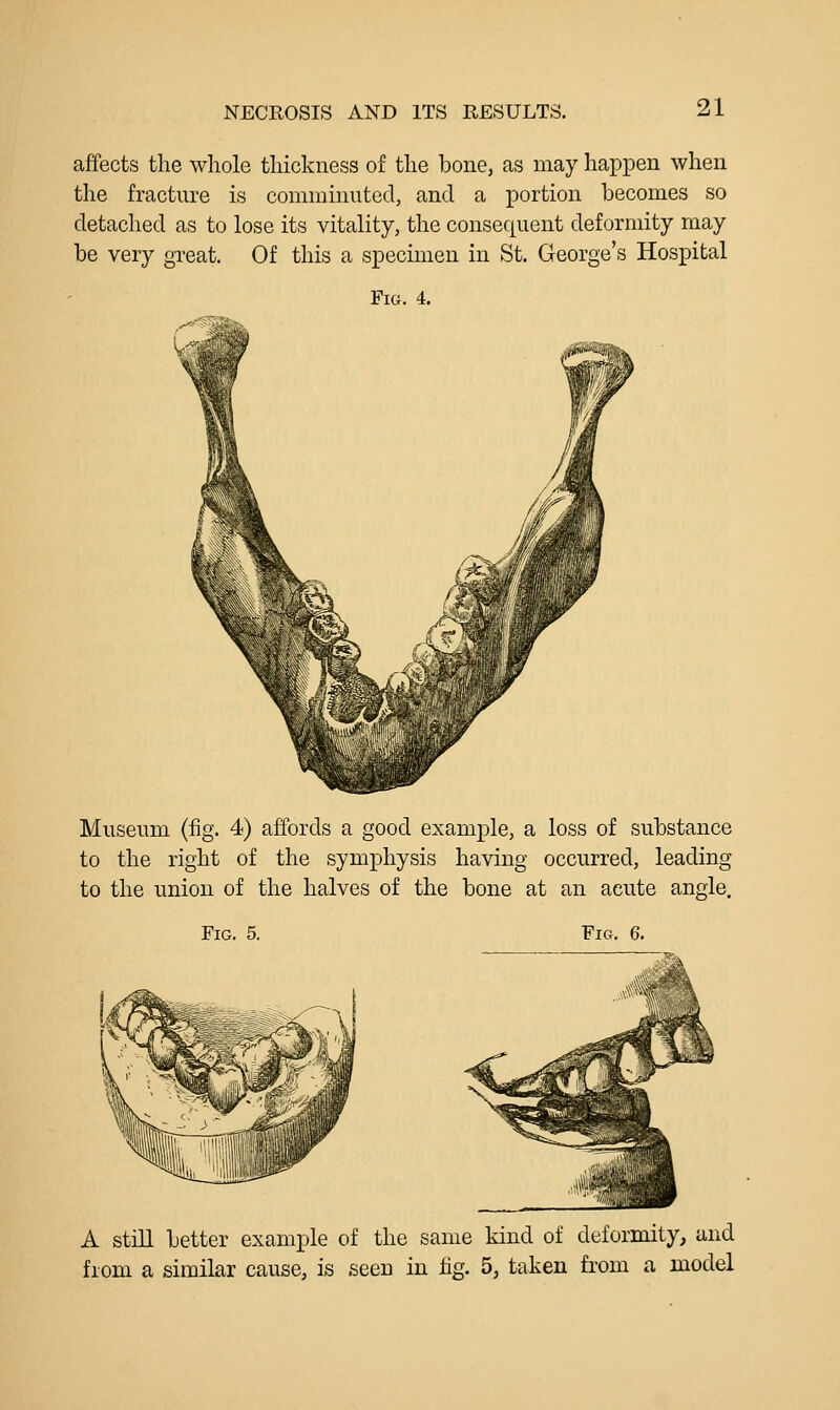 NECROSIS AND ITS RESULTS. affects the whole thickness of the bouej as may happen when the fracture is comminuted, and a portion becomes so detached as to lose its vitality, the consequent deformity may be very great. Of this a specimen in St. George's Hospital Fia. 4. Museum (fig. 4) affords a good example, a loss of substance to the right of the symphysis having occurred, leading to the union of the halves of the bone at an acute angle. Fig. 5. Fig. 6. #\ A still better example of the same kind of deformity, and from a similar cause, is .seen in fig. 5, taken fi'om a model