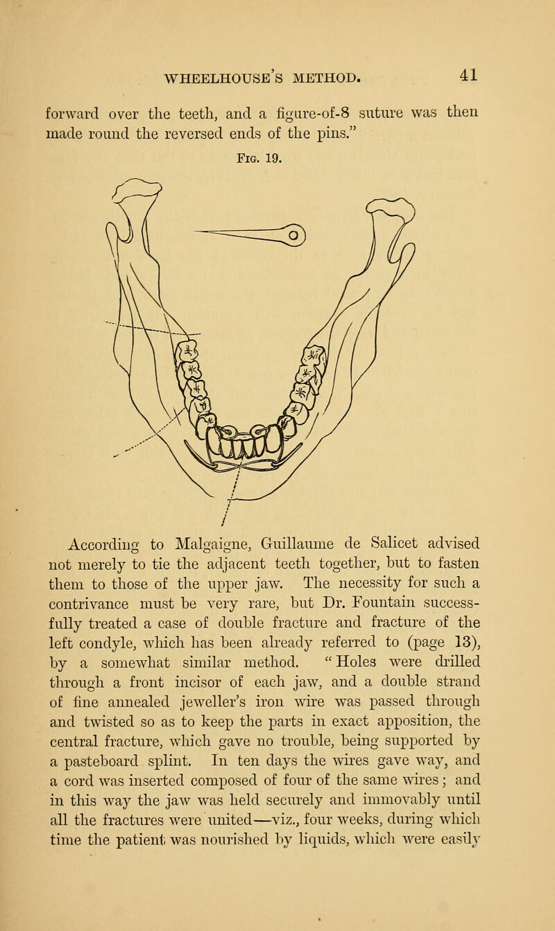 WHEELHOUSE S METHOD. forward over the teeth, and a figLire-of-8 suture was then made round the reversed ends of the pins. Fig. 19. / According to Malgaigne, Guillaume de Salicet advised not merely to tie the adjacent teeth together, but to fasten them to those of the upper jaw. The necessity for such a contrivance must he very rare, but Dr. Fountain success- fully treated a case of double fracture and fracture of the left condyle, which has been already referred to (page 13), by a somewhat similar method.  Holes were drilled through a front incisor of each jaw, and a double strand of fine annealed jeweller's iron wire was passed through and twisted so as to keep the parts in exact apposition, the central fracture, which gave no troul^le, being supported by a pasteboard splint. In ten days the wires gave way, and a cord was inserted composed of four of the same wires ; and in this way the jaw w\t,s held securely and immovably until all the fractures were united—viz., four weeks, during which time the patient was noui-ished l)y liquids, wliich were easily