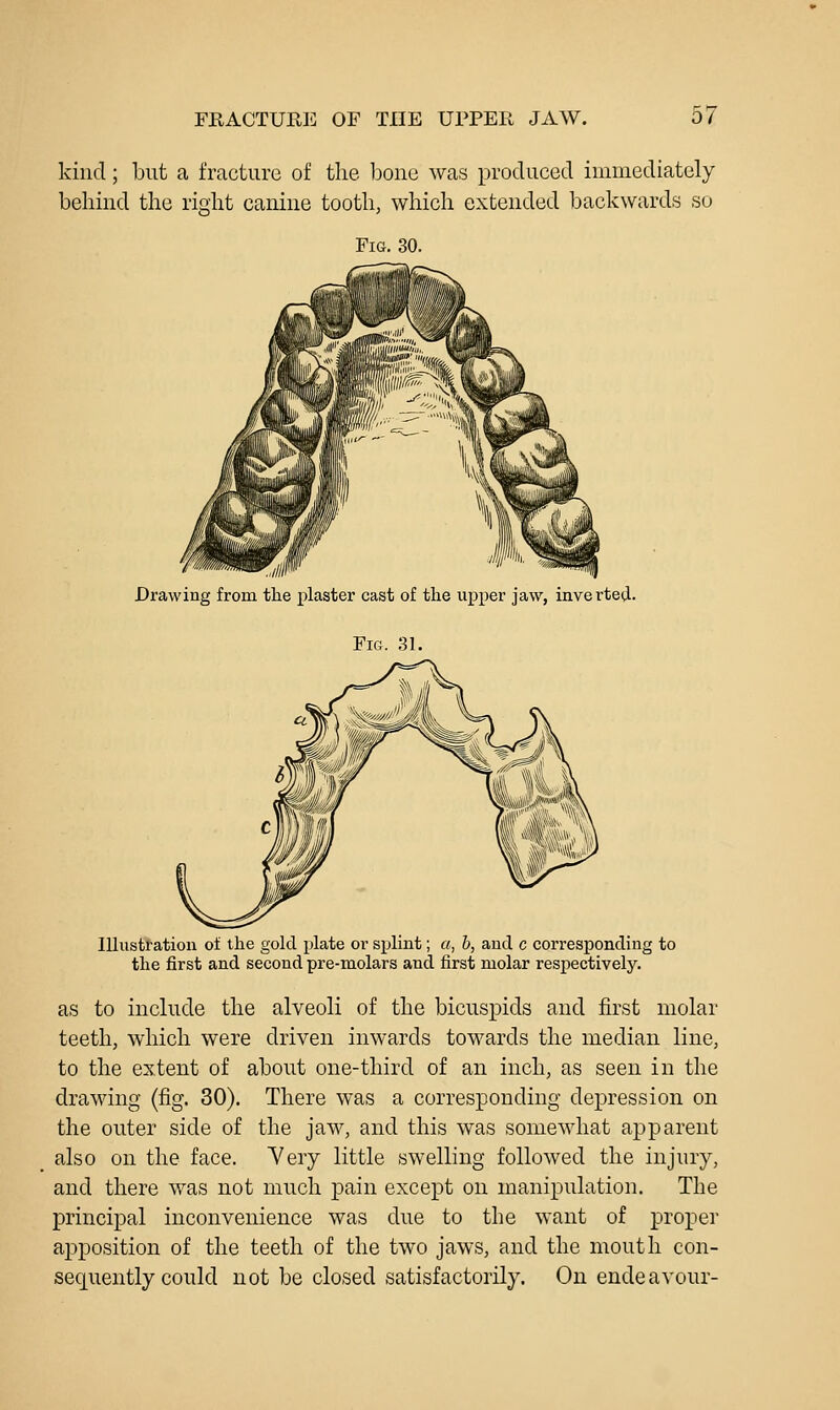 kind; but a fracture of the bone was produced immediately behind the right canine tooth, which extended backwards so Fig. 30. Drawing from the plaster cast of the upper jaw, inverteii. Fig. 31. Illustration of the gold plate or splint; a, h, and c corresponding to the first and second pre-molars and first molar respectively. as to inchide the alveoli of the bicuspids and first molar teeth, which were driven inwards towards the median line, to the extent of about one-third of an inch, as seen in the drawing (fig. 30). There was a corresponding depression on the outer side of the jaw, and this was somewhat apparent also on the face. Yery little swelling followed the injury, and there was not much pain except on manipulation. The principal inconvenience was due to the want of proper apposition of the teeth of the two jaws, and the mouth con- sequently could not be closed satisfactorily. On endeavour-