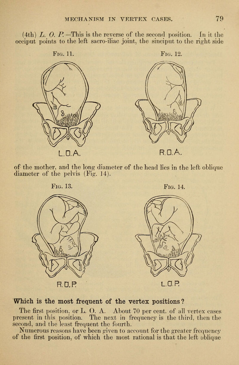 (4th) L. 0. P.—This is the reverse of the second position. In it the occiput points to the left sacro-iUac joint, the sinciput to the right side Fig. 11. Fig. 12. L.D.A. R.D.A. of the mother, and the long diameter of the head Hes in the left oblique diameter of the pelvis (Fig. 14). Fig. 13. Fig. 14. R.ap L.O.R Which is the most frequent of the vertex positions? The first position, or L. 0. A. About 70 per cent, of all vertex cases present in this position. The next in frequency is the third, then the second, and the least frequent the fourth. Numerous reasons have been given to account for the greater frequency of the first position, of which the most rational is that the left oblique