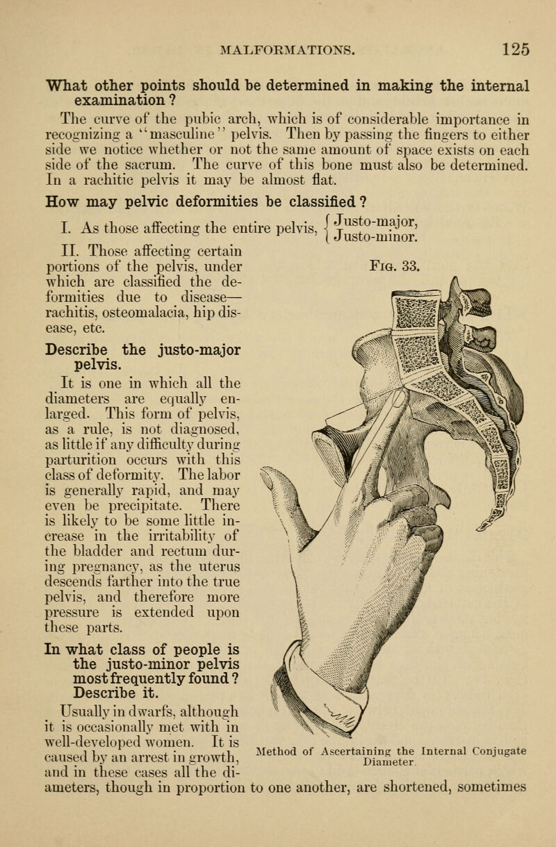Fig What other points should be determined in making the internal examination ? The curve of the pubic arch, which is of considerable importance in recognizing a ''masculine  pelvis. Then by passing the fingers to either side we notice whether or not the same amount of space exists on each side of the sacrum. The curve of this bone must also be determined. In a rachitic pelvis it may be almost flat. How may pelvic deformities be classified? I As those aff'ecting the entire pelvis, j J^^sto-major, ^ ^ ' (J usto-mmor. 11. Those affecting certain portions of the pelvis, under which are classified the de- formities due to disease— rachitis, osteomalacia, hip dis- ease, etc. Describe the justo-major pelvis. It is one in which all the diameters are equally en- larged. This form of pelvis, as a rule, is not diagnosed, as little if any difficulty during parturition occurs with this class of deformity. The labor is generally rapid, and may even be precipitate. There is likely to be some little in- crease in the irritability of the bladder and rectum dur- ing pregnancy, as the uterus descends farther into the true pelvis, and therefore more pressure is extended upon these parts. In what class of people is the justo-minor pelvis most frequently found ? Describe it. Usually in dwarfs, although it is occasionally met with in well-developed women. It is caused by an arrest in growth, and in these cases all the di- ameters, though in proportion to one another, are shortened, sometimes Method of Ascertaining the Internal Conjugate Diameter.