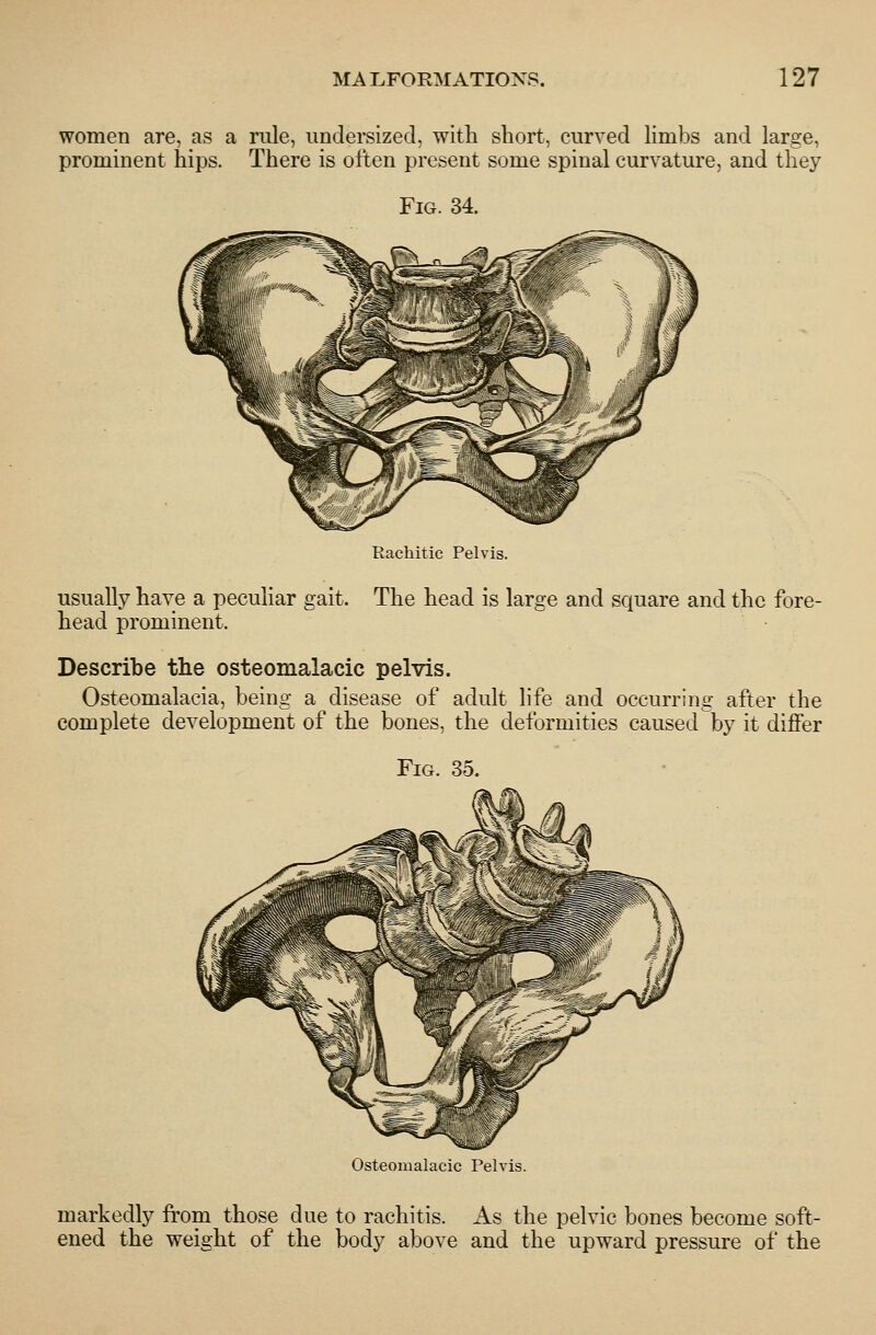 women are, as a nile, undersized, with short, curved Hmbs and large, prominent hips. There is often present some spinal curvature, and they Fig. 34. Rachitic Pelvis. usually have a peculiar gait. The head is large and square and the fore- head prominent. Describe the osteomalacic pelvis. Osteomalacia, being a disease of adult life and occurring after the complete development of the bones, the deformities caused by it differ Fig. 35. Osteomalacic Pelvis. markedly from those due to rachitis. As the pelvic bones become soft- ened the weight of the body above and the upward pressure of the