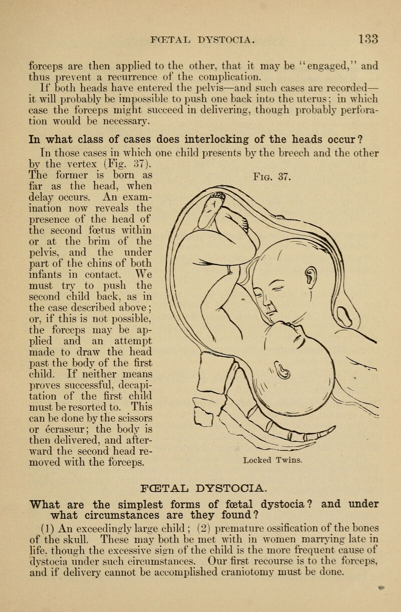 forceps are then applied to the other, that it maybe engaged, and thus prevent a reeiuTence of the complication. If both heads have entered the pelvis—and such cases are recorded— it will probably be impossible to push one back into the uterus; in which case the forceps might succeed in delivering, though probably perfora- tion would be necessary. In what class of cases does interlocking of the heads occur ? In those cases in which one child presents by the breech and the other by the vertex (Fig. _ ot). The former is born as far as the head, when delay occurs. An exam- ination now reveals the presence of the head of the second fcetus within or at the brim of the pelvis, and the under part of the chins of both infants in contact. We must try to push the second child back, as in the case described above; or, if this is not possible, the forceps may be ap- plied and an attempt made to draw the head past the body of the first child. If neither means proves successful, decapi- tation of the first child must be resorted to. This can be done by the scissors or ecraseur; the body is then delivered, and after- ward the second head re- moved with the forceps. Fig. 37. Locked Twins. FCE3TAL DYSTOCIA. What are the simplest forms of foetal dystocia? and under what circumstances are they found? (1) An exceedingly large child ; (2) premature ossification of the bones of the skull. These may both be met with in women marrying late in life, though the excessive sign of the child is the more frequent cause of dystocia under such circumstances. Our first recourse is to the forceps, and if delivery cannot be accomplished craniotomy must be done.