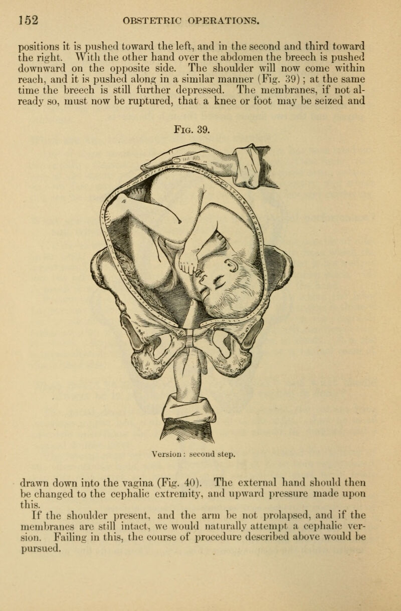 positions it is pushed toward the left, and in the second and third toward the right. With the other hand over the abdomen the breech is pushed downward on tlie opposite side. The shoulder will now come within reach, and it is pushed along in a similar manner (Fig. 39); at the same time the breech is still further depressed. The membranes, if not al- read}^ so, must now be ruptured, that a knee or foot ma}' be seized and Fig. 39. Version: second step. drawn down into the vagina (Fig. 40). The external hand should then be changed to the cephalic extremity, and upward jiressure made upon this. If the shoulder present, and the arm be not prolapsed, and if the membranes are still intact, we would naturally attempt a cephalic ver- sion. Failing in this, the course of procedure described above would be pursued.