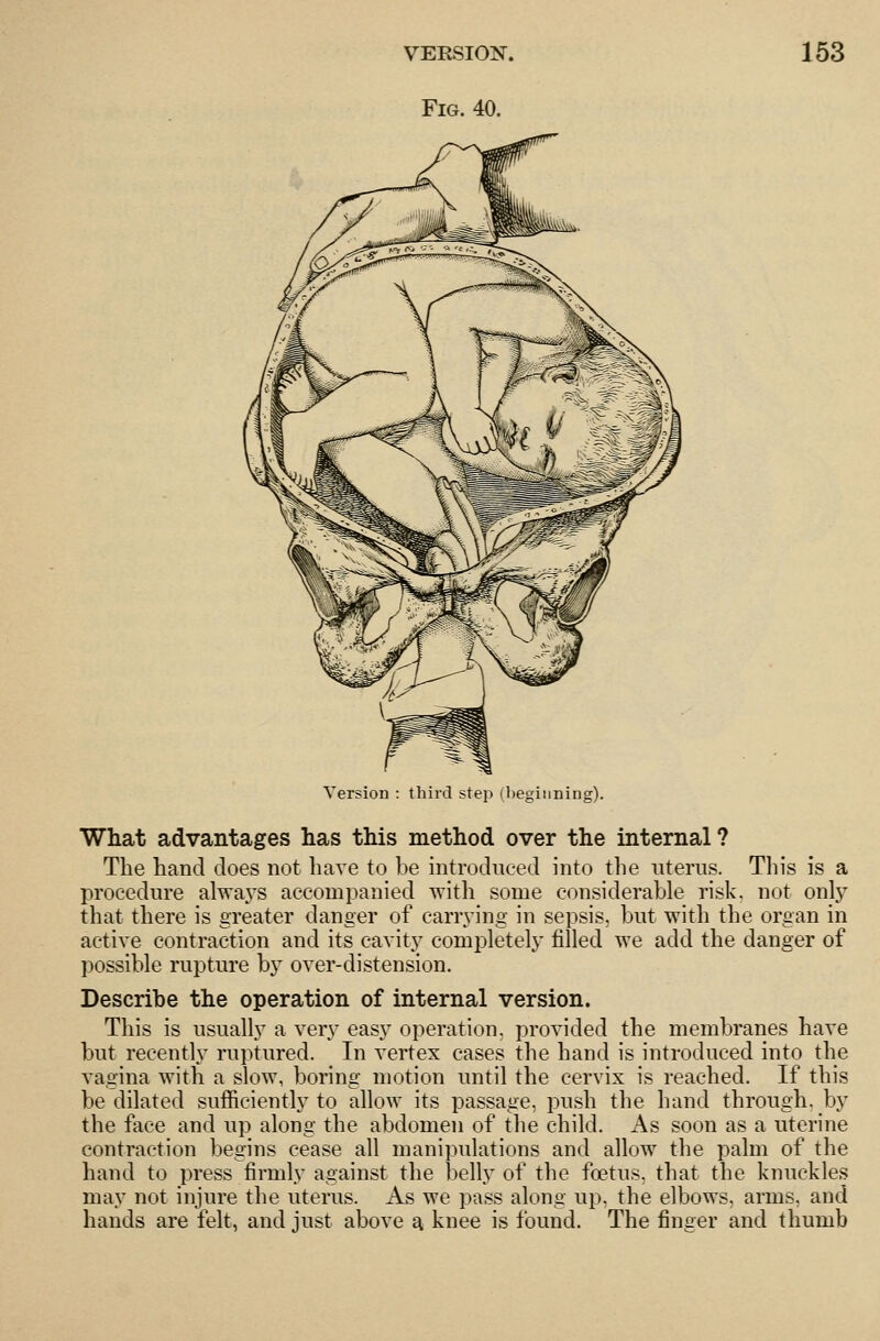 Fig. 40. Version : third step (beginning). What advantages has this method over the internal? The hand does not have to be introduced into the nterus. This is a procedure alwaj^s accompanied with some considerable risk, not only that there is greater danger of carrying in sepsis, but with the organ in active contraction and its cavity completely filled we add the danger of possible rupture by over-distension. Describe the operation of internal version. This is usually a very easy operation, provided the membranes have but recently ruptured. In vertex cases the hand is introduced into the vagina with a slow, boring motion until the cervix is reached. If this be dilated sufficiently to allow its passage, push the hand through, by the fice and up along the abdomeii of the child. As soon as a uterine contraction begins cease all manipulations and allow the palm of the hand to press firmly against the bell.y of the foetus, that the knuckles may not injure the uterus. As we pass along up, the elbows, arms, and hands are felt, and just above a knee is found. The finger and thumb