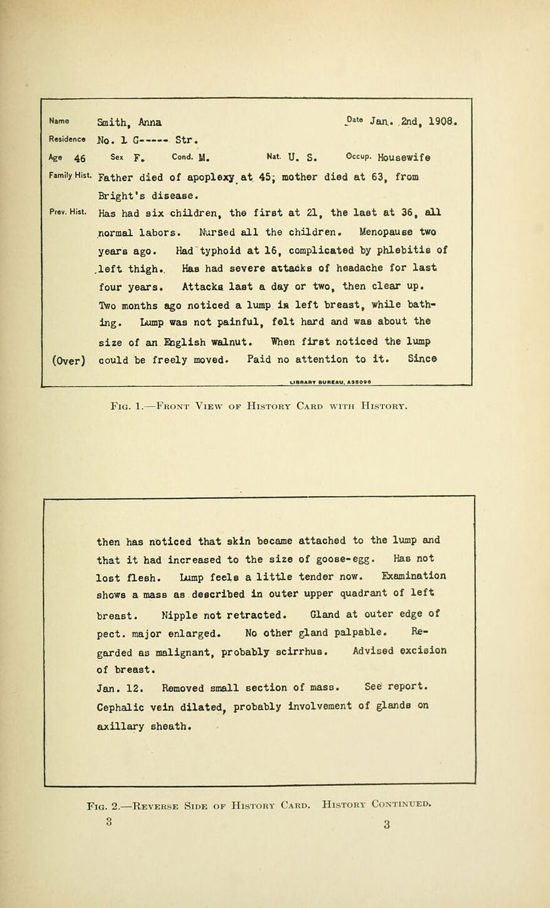 Name Smith, Anna -0ata Jan. .2nd, 1908, Residence JJ0. 1 G-—-■ Str. Age 46 Sex F. Cond. M. Nat. U. S. Occup. Housewife Family Hist. Father died of apoplexy at. 45; mother died at 63, from Bright's disease. Ptev. Hist. Has had six children, the first at 21, the last at 36, all normal labors. Nursed all the children. Menopause two years ago. Had typhoid at 16, complicated by phlebitis of .left thigh.. Has had severe attacks of headache for last four years. Attacks last a day or two, then clear up. Two months ago noticed a lump ia left breast, while bath- ing. Lump was not painful, felt hard and was about the size of an English walnut. When first noticed the lump (Over) could be freely moved. Paid no attention to it. Since (.IBRAAY BUREAU, A3S0B9 Fig. 1.—Front View of History Card with History. then has noticed that skin became attached to the lump and that it had increased to the size of goose-egg. Has not lost flesh. Lump feels a little tender now. Examination shows a mass as described in outer upper quadrant of left breast. Nipple not retracted. Gland at outer edge of pect. major enlarged. No other gland palpable. Re- garded as malignant, probably scirrhus. Advised excision of breast. Jan. 12. Removed small section of mass. See' report. Cephalic vein dilated, probably involvement of glands on axillary sheath. Fig. 2.—Reverse Side of History Card. History Continued.