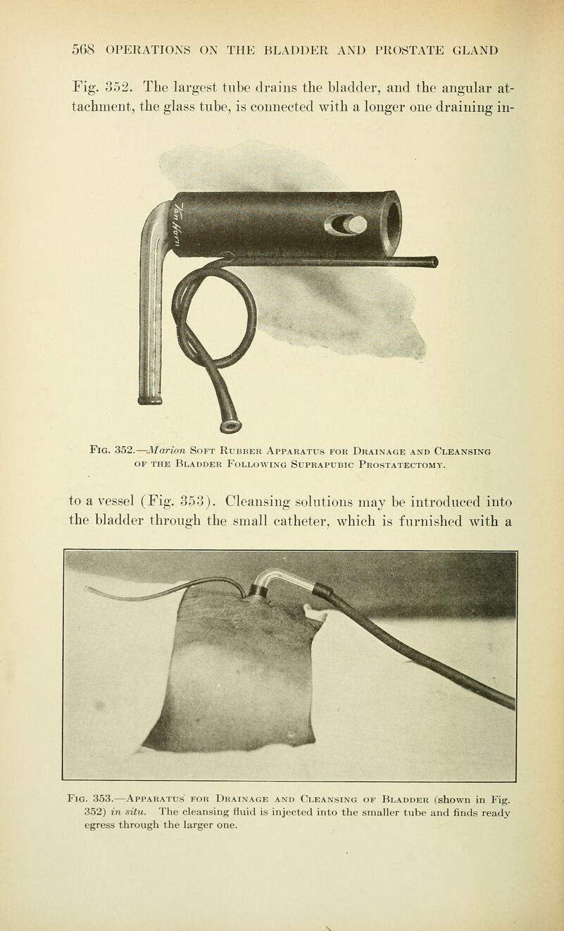 Fig. 352. The largest tube drains the bladder, and the angular at- tachment, the glass tube, is connected with a longer one draining in- Fig. 352.—Marion Soft Rubber Apparatus for Drainage and Cleansing of the Bladder Following Suprapubic Prostatectomy. to a vessel (Fig. 353). Cleansing solutions may be introduced into the bladder through the small catheter, which is furnished with a Fig. 353.—Apparatus for Drainage and Cleansing of Bladder (shown in Fig. 352) in situ. The cleansing fluid is injected into the smaller tube and finds ready egress through the larger one.