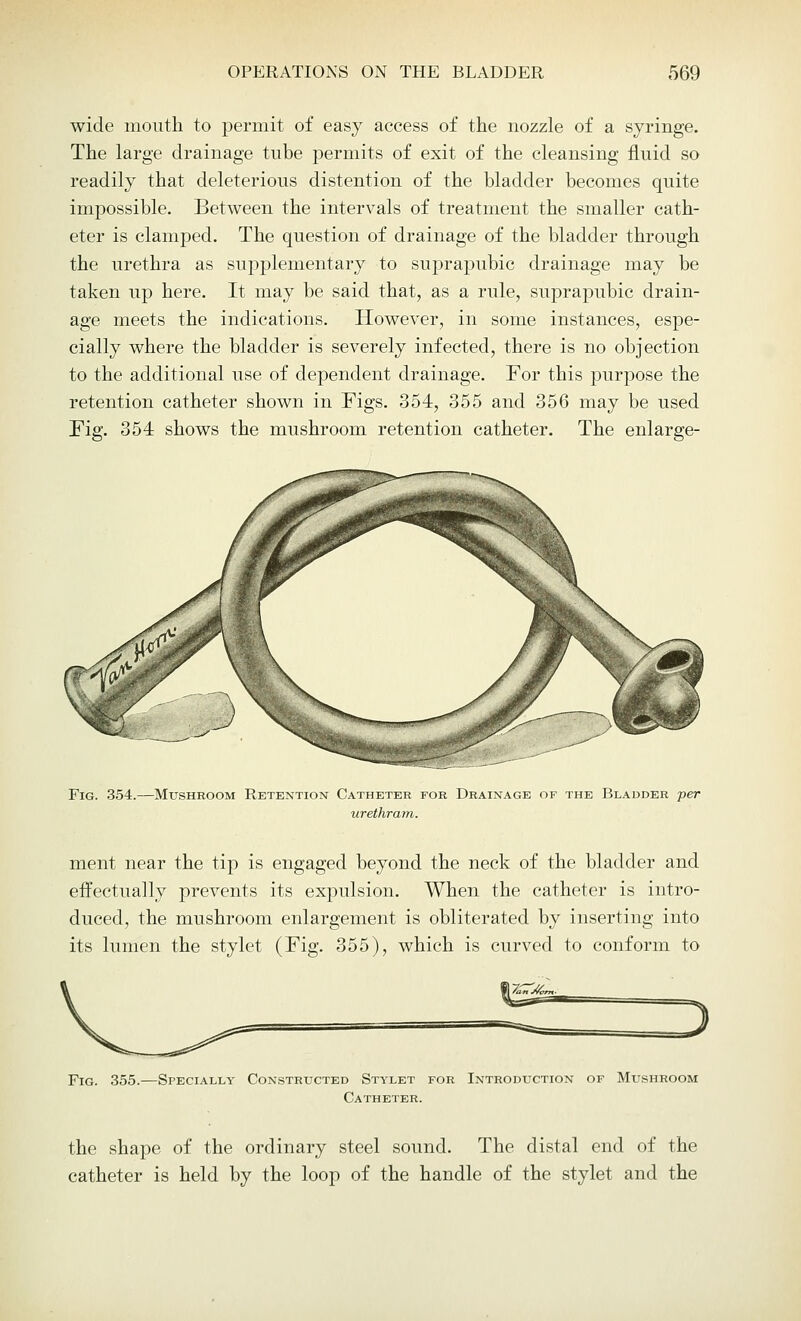 wide mouth to permit of easy access of the nozzle of a syringe. The large drainage tube permits of exit of the cleansing fluid so readily that deleterious distention of the bladder becomes quite inrpossible. Between the intervals of treatment the smaller cath- eter is clamped. The question of drainage of the bladder through the urethra as supplementary to suprapubic drainage may be taken up here. It may be said that, as a rule, suprapubic drain- age meets the indications. However, in some instances, espe- cially where the bladder is severely infected, there is no objection to the additional use of dependent drainage. For this purpose the retention catheter shown in Figs. 354, 355 and 356 may be used Fig. 354 shows the mushroom retention catheter. The enlarge- Fig. 354.—Mushroom Retention Catheter for Drainage of the Bladder per urethram. ment near the tip is engaged beyond the neck of the bladder and effectually prevents its expulsion. When the catheter is intro- duced, the mushroom enlargement is obliterated by inserting into its lumen the stylet (Fig. 355), which is curved to conform to Fig. 355. -Specially Constructed Stylet for Introduction of Mushroom Catheter. the shape of the ordinary steel sound. The distal end of the catheter is held by the loop of the handle of the stylet and the