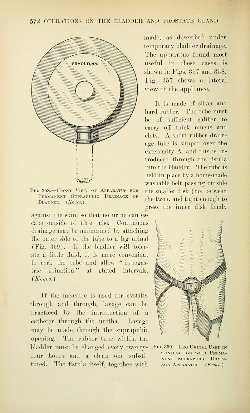 made, as described under temporary bladder drainage. The apparatus found most useful in these cases is shown in Figs. 357 and 358. Fig. 357 shows a lateral view of the appliance. It is made of silver and hard rubber. The tube must be of sufficient caliber to carry off thick mucus and clots. A short rubber drain- age tube is slipped over the exteremity A, and this is in- troduced through the fistula into the bladder. The tube is held in place by a home-made washable belt passing outside the smaller disk (not between the two), and tight enough to press the inner disk firmly against the skin, so that no urine can es- cape outside of the tube. Continuous drainage may be maintained by attaching the outer side of the tube to a leg urinal (Fig. 359). If the bladder will toler- ate a little fluid, it is more convenient to cork the tube and allow  hypogas- tric urination at stated intervals. (Keyes.) Fig. 358.—Front View of Apparatus for Permanent Sltprapubic Drainage of Bladder. '(Keyes.) through If the measure is used for cystitis and through, lavage can be practiced by the introduction of a catheter through the uretha. Lavage may be made through the suprapubic opening. The rubber tube within the bladder must be changed every twenty- Fig. 359.—Leg Urinal Used in xi it 1 , • Conjunction with Perma- tour hours and a clean one substi- _ T a t. nent Suprapubic Drain- tuted. The fistula itself, together with age Apparatus. {Kexjes.)