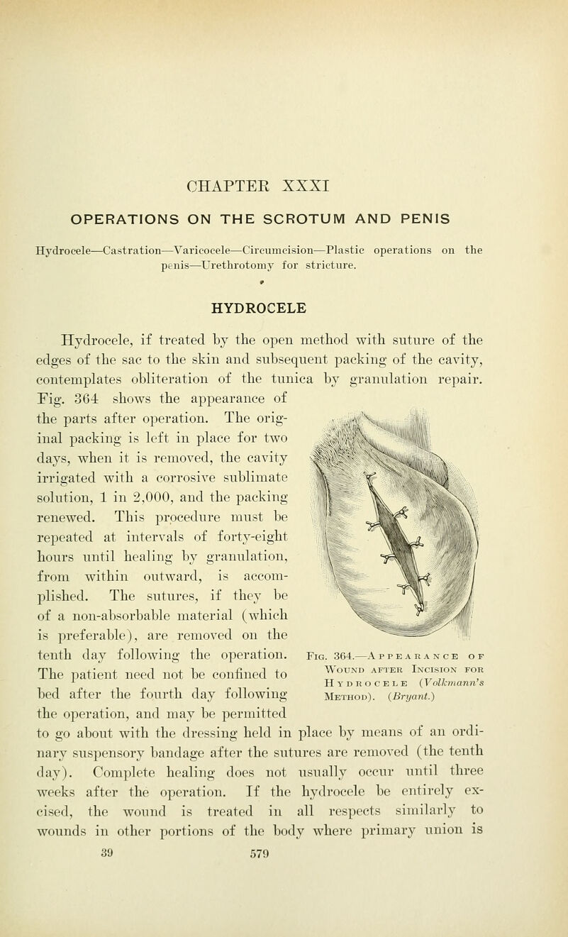 CHAPTER XXXI OPERATIONS ON THE SCROTUM AND PENIS Hydrocele—Castration—Varicocele—Circumcision—Plastic operations on the penis—Urethrotomy for stricture. HYDROCELE Hydrocele, if treated by the open method with suture of the edges of the sac to the skin and subsequent packing of the cavity, contemplates obliteration of the tunica by granulation repair. Fig. 364 shows the appearance of the parts after operation. The orig- inal packing is left in place for two days, when it is removed, the cavity irrigated with a corrosive sublimate solution, 1 in 2,000, and the packing renewed. This procedure must be repeated at intervals of forty-eight hours until healing by granulation, from within outward, is accom- plished. The sutures, if they be of a non-absorbable material (which is preferable), are removed on the tenth day following the operation. The patient need not be confined to bed after the fourth day following the operation, and may be permitted to go about with the dressing held in place by means of an ordi- nary suspensory bandage after the sutures are removed (the tenth day). Complete healing does not usually occur until three weeks after the operation. If the hydrocele be entirely ex- cised, the wound is treated in all respects similarly to wounds in other portions of the body where primary union is 39 579 Fig. 364.—A ppearance of Wound after Incision for Hydrocele (Volkmann's Method). (Bryant.)