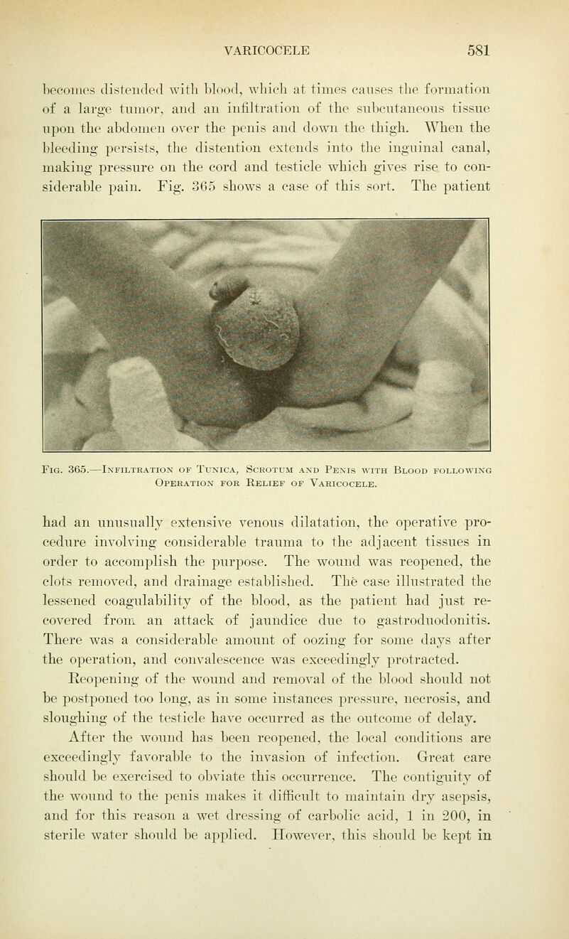 becomes distended with blood, which at times causes the formation of a large tumor, and an infiltration of the subcutaneous tissue upon the abdomen over the penis and down the thigh. When the bleeding persists, the distention extends into the inguinal canal, making pressure on the cord and testicle which gives rise to con- siderable pain. Fig. 365 shows a case of this sort. The patient Fig. 365.—Infiltration of Tunica, Scrotum and Penis with Blood following Operation for Relief of Varicocele. had an unusually extensive venous dilatation, the operative pro- cedure involving considerable trauma to the adjacent tissues in order to accomplish the purpose. The wound was reopened, the clots removed, and drainage established. The case illustrated the lessened coagulability of the blood, as the patient had just re- covered from an attack of jaundice due to gastroduodonitis. There was a considerable amount of oozing for some days after the operation, and convalescence was exceedingly protracted. Reopening of the wound and removal of the blood should not be postponed too long, as in some instances pressure, necrosis, and sloughing of the testicle have occurred as the outcome of delay. After the wound has been reopened, the local conditions are exceedingly favorable to the invasion of infection. Great care should be exercised to obviate this occurrence. The contiguity of the wound to the penis makes it difficult to maintain dry asepsis, and for this reason a wet dressing of carbolic acid, 1 in 200, in sterile water should be applied. However, this should be kept in