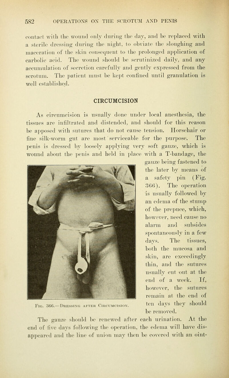 contact with the wound only during the day, and be replaced with a sterile dressing during the night, to obviate the sloughing and maceration of the skin consequent to the prolonged application of carbolic acid. The wound should be scrutinized daily, and any accumulation of secretion carefully and gently expressed from the scrotum. The patient must be kept confined until granulation is well established. CIRCUMCISION As circumcision is usually done under local anesthesia, the tissues are infiltrated and distended, and should for this reason be apposed with sutures that do not cause tension. Horsehair or fine silk-worm gut are most serviceable for the purpose. The penis is dressed by loosely applying very soft gauze, which is wound about the penis and held in place with a T-bandage, the gauze being fastened to the later by means of a safety pin (Fig. 366). The operation is usually followed by an edema of the stump of the prepuce, which, however, need cause no alarm and subsides spontaneously in a few days. The tissues, both the mucosa and skin, are exceedingly thin, and the sutures usually cut out at the end of a week. If, however, the sutures remain at the end of ten days they should be removed. The gauze should be renewed after each urination. At the end of five days following the operation, the edema will have dis- appeared and the line of union may then be covered with an oint- Fig. 366.—Dressing after Circumcision.