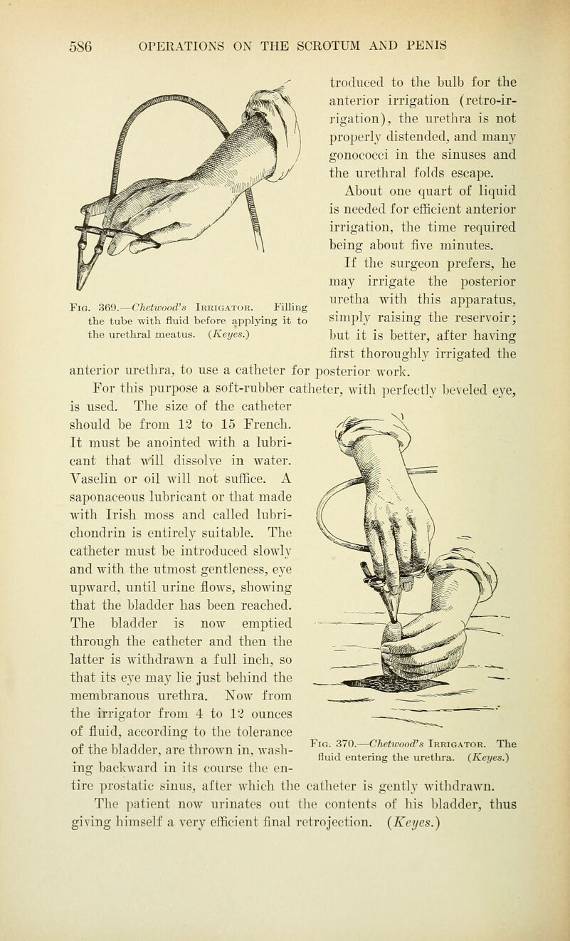 Fig. 369.—Chetwood's Irrigator. Filling the tube with fluid before applying it to the urethral meatus. (Keyes.) troduced to the bulb for the anterior irrigation (retro-ir- rigation), the urethra is not properly distended, and many gonococci in the sinuses and the urethral folds escape. About one quart of liquid is needed for efficient anterior irrigation, the time required being about five minutes. If the surgeon prefers, he may irrigate the posterior uretha with this apparatus, simply raising the reservoir; but it is better, after having first thoroughl}' irrigated the anterior urethra, to use a catheter for posterior work. For this purpose a soft-rubber catheter, with perfectly beveled eye, is used. The size of the catheter should be from 12 to 15 French. It must be anointed with a lubri- cant that will dissolve in water. Vaselin or oil will not suffice. A saponaceous lubricant or that made with Irish moss and called lubri- chondrin is entirely suitable. The catheter must be introduced slowly and with the utmost gentleness, eye upward, until urine flows, showing that the bladder has been reached. The bladder is now emptied through the catheter and then the latter is withdrawn a full inch, so that its eye may lie just behind the membranous urethra. Now from the irrigator from 4 to 12 ounces of fluid, according to the tolerance of the bladder, are thrown in, wash- ing backward in its course the en- tire prostatic sinus, after which the catheter is gently withdrawn. The patient now urinates out the contents of his bladder, thus giving himself a very efficient final retrojection. (Keyes.) Fig. 370.—Chetwood's Irrigator. The fluid entering the urethra. (Keyes.)