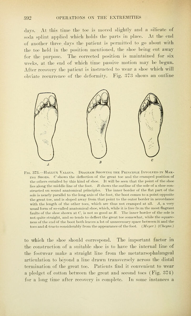 days. At this time the toe is moved slightly and a silicate of soda splint applied which holds the parts in place. At the end of another three days the patient is permitted to go about with the toe held in the position mentioned, the shoe being cut away for the purpose. The corrected position is maintained for six weeks, at the end of which time passive motion may be begun. After recovery the patient is instructed to wear a shoe which will obviate recurrence of the deformity. Fig. 373 shows an outline Fig. 373.—Hallux Valgus. Diagram Showing the Principle Involved in Mak- ing Shoes. C shows the deflection of the great toe and the cramped position of the others entailed by this kind of shoe. It will be seen that the point of the shoe lies along the middle line of the foot. B shows the outline of the sole of a shoe con- structed on sound anatomical principles. The inner border of the flat part of the sole is nearly parallel to the long axis of the foot, the boot comes to a point opposite the great toe, and is sloped away from that point to the outer border in accordance with the length of the other toes, which are thus not cramped at all. A, a very usual form of so-called anatomical shoe, which, while it is free frcm the most flagrant faults of the shoe shown at C, is not so good as B. The inner border of the sole is not quite straight, and so tends to deflect the great toe somewhat, while the square- ness of the end of the boot both leaves a lot of unnecessary space between it and the toes and detracts considerably from the appearance of the foot. (Meyer.) (Cheyne.) to which the shoe should correspond. The important factor in the construction of a suitable shoe is to have the internal line of the footwear make a straight line from the metatarsophalangeal articulation to beyond a line drawn transversely across the distal termination of the great toe. Patients find it convenient to wear a pledget of cotton between the great and second toes (Fig. 374) for a long time after recovery is complete. In some instances a
