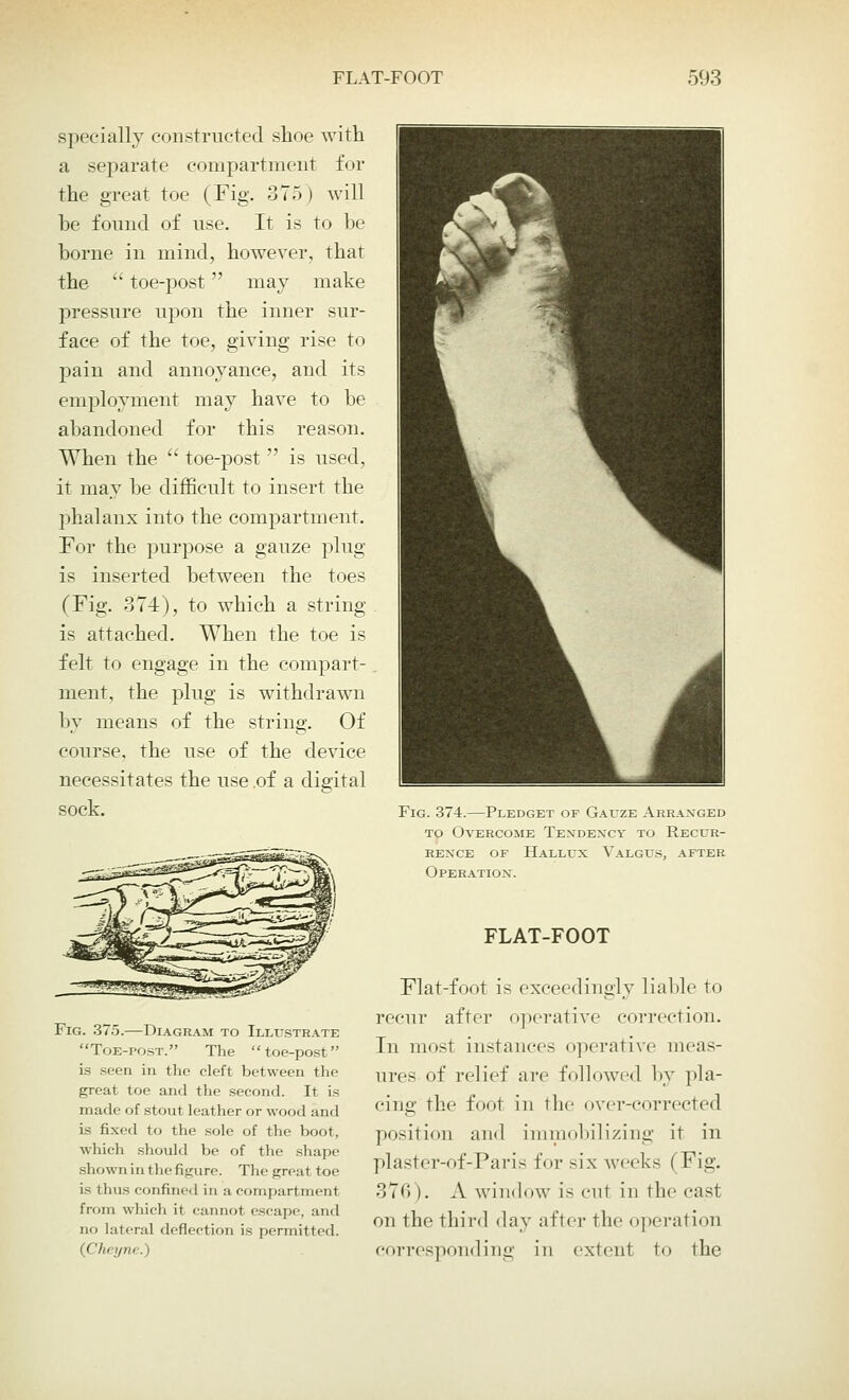 specially constructed shoe with a separate compartment for the great toe (Fig. 375) will be found of use. It is to be borne in mind, however, that the  toe-post may make pressure upon the inner sur- face of the toe, giving rise to pain and annoyance, and its employment may have to be abandoned for this reason. When the  toe-post  is used, it may be difficult to insert the phalanx into the compartment. For the purpose a gauze plug is inserted between the toes (Fig. 374), to which a string- is attached. When the toe is felt to engage in the compart- ment, the plug is withdrawn by means of the string. Of course, the use of the device necessitates the use,of a digital sock. Fig. 375.—Diagram to Illustrate Toe-post. The toe-post is seen in the cleft between the great toe and the second. It is made of stout leather or wood and is fixed to the sole of the boot, which should be of the shape shown in the figure. The great toe is thus confined in a compartment from which it cannot escape, and no lateral deflection is permitted. (Cheyne.) Fig. 374.—Pledget of Gauze Arranged to Overcome Tendency to Recur- rence of Hallux Valgus, after Operation. FLAT-FOOT Flat-foot is exceedingly liable to recur after operative correction. In most instances operative meas- ures of relief are followed by pla- cing the foot in the over-corrected position and immobilizing it in plaster-of-Paris for six week- (Fig. 376). A window is cu1 in tliocast on the third day after the operation corresponding in extent to the