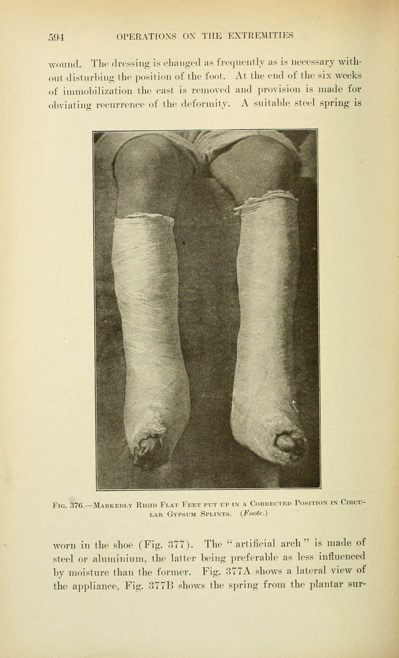 wound. The dressing is changed as frequently as is necessary with- out disturbing the position of the foot. At the end of the six weeks of immobilization the cast is removed and provision is made for obviating recurrence of the deformity. A suitable steel spring is Fig. 376.—Markedly Rigid Flat Feet put up in a Corrected Position in Circu- lar Gypsum Splints. (Foote.) worn in the shoe (Fig. 377). The  artificial arch is made of steel or aluminium, the latter being preferable as less influenced by moisture than the former. Fig. 377A shows a lateral view of the appliance, Fig. 377B shows the spring from the plantar sur-