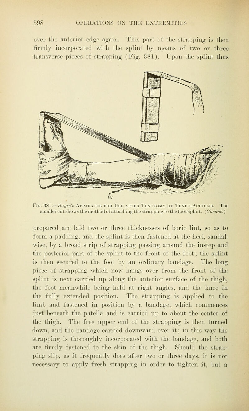 over the anterior edge again. This part of the strapping is then firmly incorporated with the splint by means of two or three transverse pieces of strapping (Fig. 381). Upon the splint thus Fig. 381.—Sayre's Apparatus for Use after Tenotomy of Tendo-A chillis.- The smaller cut shows the method of attaching the strapping to the foot splint. (Cheyne.) prepared are laid two or three thicknesses of boric lint, so as to form a padding, and the splint is then fastened at the heel, sandal- wise, by a broad strip of strapping passing aronnd the instep and the posterior part of the splint to the front of the foot; the splint is then secured to the foot by an ordinary bandage. The long piece of strapping which now hangs over from the front of the splint is next carried np along the anterior surface of the thigh, the foot meanwhile being held at right angles, and the knee in the fully extended position. The strapping is applied to the limb and fastened in position by a bandage, which commences just beneath the patella and is carried up to about the center of the thigh. The free upper end of the strapping is then turned down, and the bandage carried downward over it; in this way the strapping is thoroughly incorporated with the bandage, and both are firmly fastened to the skin of the thigh. Should the strap- ping slip, as it frequently does after two or three days, it is not necessary to apply fresh strapping in order to tighten it, but a