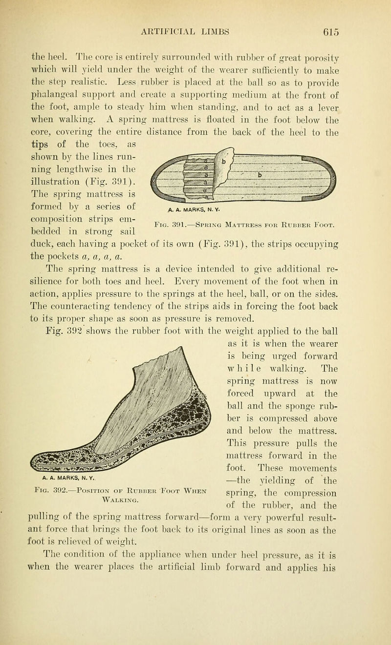 A- A. MARKS, N. Y. Fig. 391.—Spring Mattress for Rubber Foot. the heel. The core is entirely surrounded with rubber of great porosity which will yield under the weight of the wearer sufficiently to make the step realistic. Less rubber is placed at the ball so as to provide phalangeal support and create a supporting medium at the front of the foot, ample to steady him when standing, and to act as a lever when walking. A spring mattress is floated in the foot below the core, covering the entire distance from the back of the heel to the tips of the toes, as shown b}' the lines run- ning lengthwise in the illustration (Fig. 391). The spring mattress is formed by a series of composition strips em- bedded in strong sail duck, each having a pocket of its own (Fig. 391), the strips occupying the pockets a, a, a, a. The spring mattress is a device intended to give additional re- silience for both toes and heel. Every movement of the foot when in action, applies pressure to the springs at the heel, ball, or on the sides. The counteracting tendency of the strips aids in forcing the foot back to its proper shape as soon as pressure is removed. Fig. 392 shows the rubber foot with the weight applied to the ball as it is when the wearer is being urged forward while walking. The spring mattress is now forced upward at the ball and the sponge rub- ber is compressed above and below the mattress. This pressure pulls the mattress forward in the foot. These movements —the yielding of the spring, the compression of the rubber, and the pulling of the spring mattress forward—form a very powerful result- ant force that brings the foot back to its original lines as soon as the foot is relieved of weight. The condition of the appliance when under heel pressure, as it is when the wearer places the artificial limb forward and applies his a. a. marks, n. y. Fig. 392.—Position of Rubber Foot When Walking.