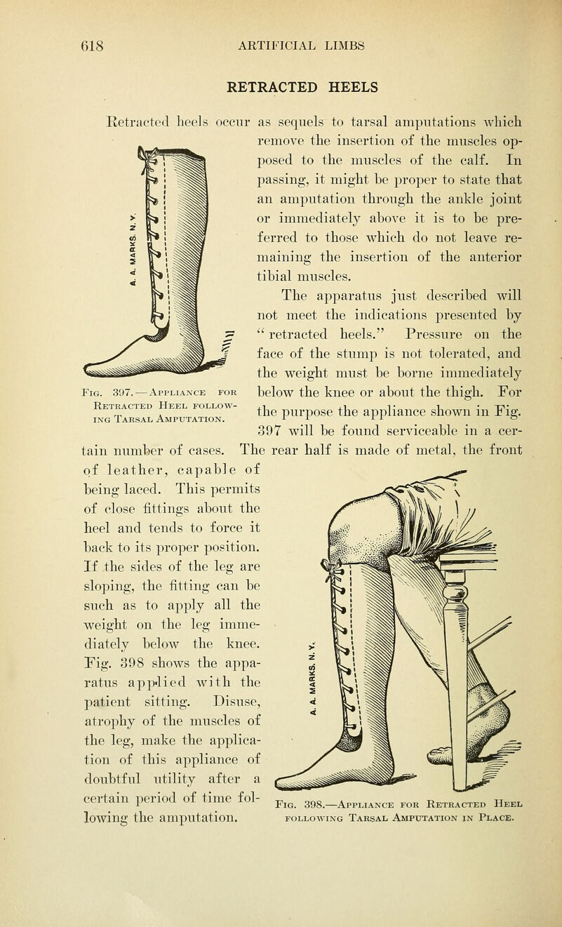RETRACTED HEELS Fig. 397. — Appliance for Retracted Heel follow- ing Tarsal Amputation. Retracted heels occur as sequels to tarsal amputations which remove the insertion of the muscles op- posed to the muscles of the calf. In passing, it might be proper to state that an amputation through the ankle joint or immediately above it is to be pre- ferred to those which do not leave re- maining the insertion of the anterior tibial muscles. The apparatus just described will not meet the indications presented by  retracted heels. Pressure on the face of the stump is not tolerated, and the weight must be borne immediately below the knee or about the thigh. For the purpose the appliance shown in Fig. 397 will be found serviceable in a cer- tain number of cases. The rear half is made of metal, the front of leather, capable of being laced. This permits of close fittings about the heel and tends to force it back to its proper position. If the sides of the leg are sloping, the fitting can be such as to apply all the weight on the leg imme- diately below the knee. !Fig. 398 shows the appa- ratus applied with the patient sitting. Disuse, atrophy of the muscles of the leg, make the applica- tion of this appliance of doubtful utility after a certain period of time fol- lowing the amputation. Fig. 398.—Appliance for Retracted Heel following Tarsal, Amputation in Place.