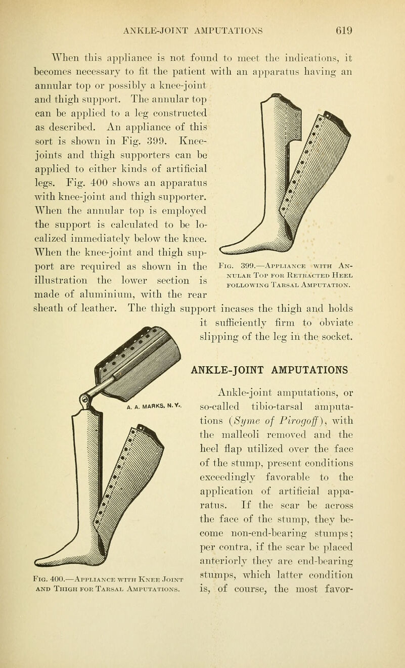 Fig. 399.—Appliance with An- nular Top for Retracted Heel following Tarsal Amputation. When this appliance is not found to meet the indications, it becomes necessary to fit the patient with an apparatus having an annular top or possibly a knee-joint and thigh support. The annular top can be applied to a leg constructed as described. An appliance of this sort is shown in Fig. 399. Knee- joints and thigh supporters can be applied to either kinds of artificial legs. Fig. 400 shows an apparatus with knee-joint and thigh supporter. When the annular top is employed the support is calculated to be lo- calized immediately below the knee. When the knee-joint and thigh sup- port are required as shown in the illustration the lower section is made of aluminium, with the rear sheath of leather. The thigh support incases the thigh and holds it sufficiently firm to obviate slipping of the leg in the socket. ANKLE-JOINT AMPUTATIONS Ankle-joint amputations, or so-called tibio-tarsal amputa- tions (Syme of Pirogoff), with the malleoli removed and the heel flap utilized over the face of the stump, present conditions exceedingly favorable to the application of artificial appa- ratus. If the scar be across the face of the stump, they be- come non-end-bearing stumps; per contra, if the scar be placed anteriorly they are end-bearing Fig. 400,-Appliance with Knee Joint blimps, which latter condition and Thigh for Tarsal Amputations. is, of COUl'Se, the most f aVOl'-