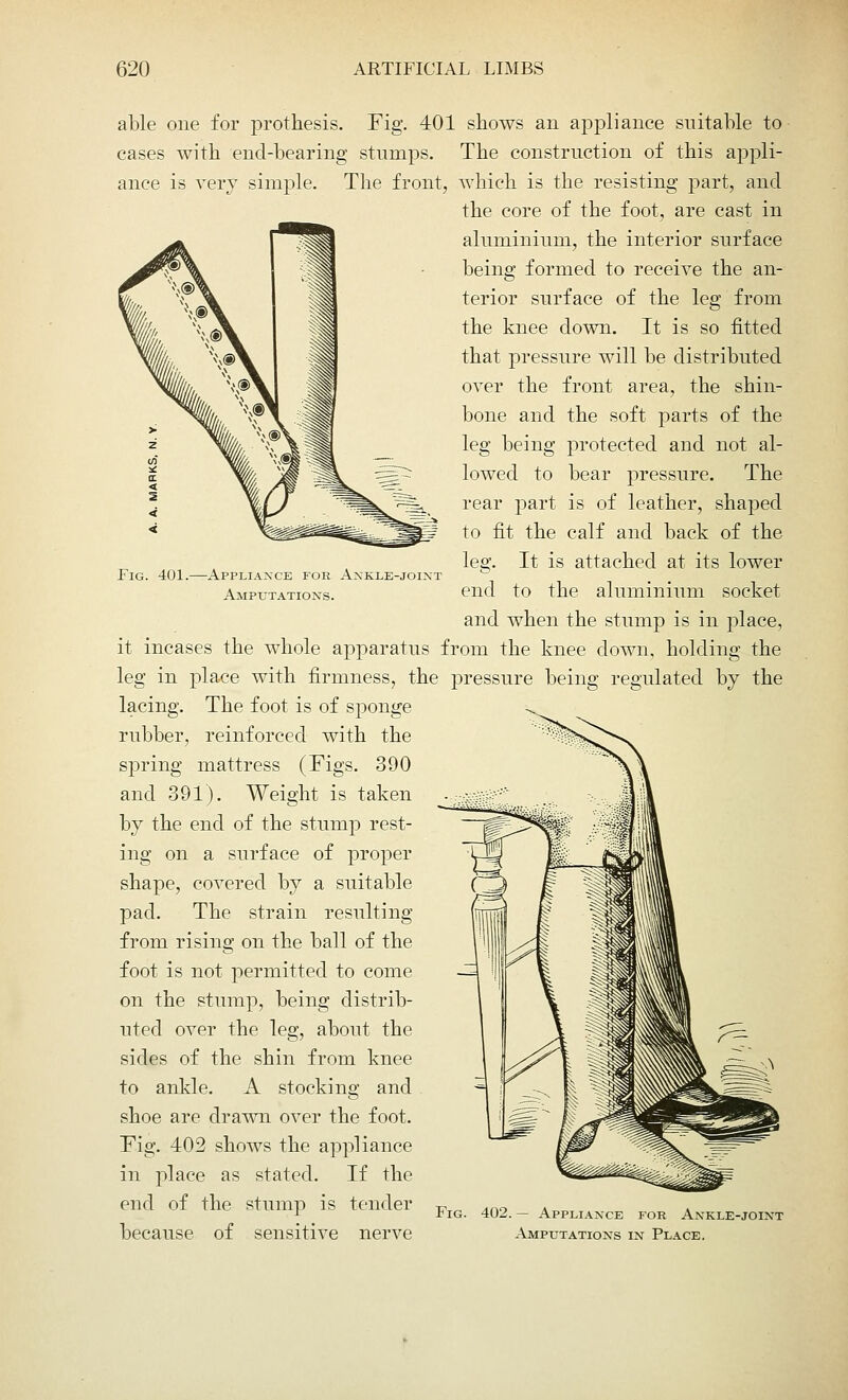 able one for prothesis. Fig. 401 shows an appliance suitable to cases with end-bearing stumps. The construction of this appli- ance is very simple. The front, Fig. 401. -Appliance for Ankle-joint Amputations. which is the resisting part, and the core of the foot, are cast in aluminium, the interior surface being formed to receive the an- terior surface of the leg from the knee down. It is so fitted that pressure will be distributed over the front area, the shin- bone and the soft parts of the leg being protected and not al- lowed to bear pressure. The rear part is of leather, shaped to fit the calf and back of the leg. It is attached at its lower end to the aluminium socket and when the stump is in place, it incases the whole apparatus from the knee down, holding the leg in place with firmness, the pressure being regulated by the lacing. The foot is of sponge rubber, reinforced with the spring mattress (Figs. 390 and 391). Weight is taken by the end of the stump rest- ing on a surface of proper shape, covered by a suitable pad. The strain resulting from rising on the ball of the foot is not permitted to come on the stump, being distrib- uted over the leg, about the sides of the shin from knee to ankle. A stocking and shoe are drawn over the foot. Fig. 402 shows the appliance in place as stated. If the end of the stump is tender *, ino . . i .biG. 402.— Appliance for Ankle-joint because of sensitive nerve Amputations in Place.