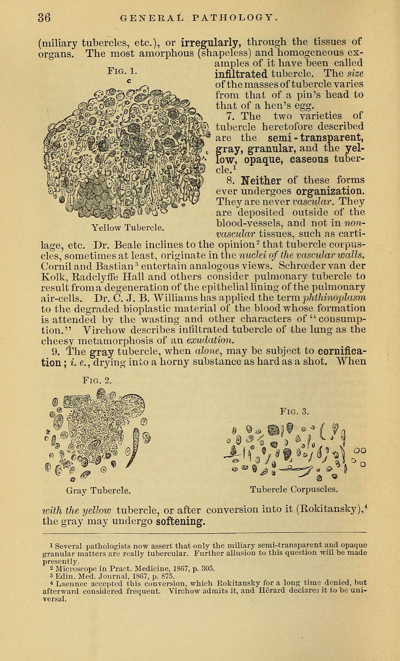 Yellow Tubercle. (miliary tubercles, etc.), or irregularly, through the tissues of organs. The most amorphous (shapeless) and homogeneous ex- amples of it have been called ^i^-1- infiltrated tubercle. The size of the masses of tubercle varies from that of a pin's head to that of a hen's egg. 7. The two varieties of tubercle heretofore described are the semi - transparent, gray, granular, and the yel- low, opaque, caseous tuber- cle.^ 8. Neither of these forms ever undergoes organization. They are never rasCT6?ar. They are deposited outside of the blood-vessels, and not in non- vascular tissues, such as carti- lage, etc. Dr. Beale inclines to the opinion^ that tubercle corpus- cles, sometimes at least, originate in the nuclei of the vascular walls. Cornil and Bastian^ entertain analogous views. Schroeder van der Kolk, Eadclyffe Hall and others consider pulmonary tubercle to result from a degeneration of the epitheliallining of the pulmonary air-cells. Dr. C. J. B. Williams has applied the term phthinoplasm to the degraded bioplastic material of the blood whose formation is attended by the wasting and other characters of  consump- tion. Yirchow describes infiltrated tubercle of the lung as the cheesy metamorphosis of an exudation. 9. The gray tubercle, when alone^ may be subject to cornifica- tion; i. e., drying into a horny substance as hard as a shot. Fig. 2. Fig. 3. oo When Gray Tubercle. Tubercle Corpuscles with the yellow tubercle, or after conversion into it (Eokitansky),^ the gray may undergo softening. 1 Several pathologists now assert that only the miliary semi-transparent and opaque granular matters are really tubercular. Further allusion to this question will be made presently. 2 Microscope in Pract. Medicine, 1867, p. 305. 3 Edin. Med. Journal, 1867, p. 875. 4 Laeimec accepted this conversion, which Rokitansky for a long time denied, but afterward considered frequent. Virchow admits it, and Herard declares it to be uni- versal.