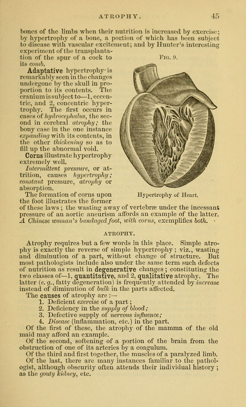 A T 11 () P II Y HyijerCropiiy of Heart. bones of the limbs when their nutrition is increased by exercise; by hj-^pertropliy of a bone, a portion of which has l)een subject to disease with vascular excitement; and by Hunter's interesting experiment of the transplanta- tion of the spur of a cock to Fig. 9. its comb. Adaptative hypertrophy is remarkably seen in tlie changes undergone l)y the skull in pro- portion to its contents. The cranium is subject to—1, eccen- tric, and 2, concentric hyper- trophy. The first occurs in cases of Ivjdrocephahis^ the sec- ond in cerebral atrophy; the bony case in the one instance expandimj with its contents, in the other thickening so as to fill up the abnormal void. Corns illustrate hypertrophy extremely well. Intennittent pressure^ or at- trition, causes hypertrophy; constant pressure, atrophy or absorption. The formation of corns upon the foot illustrates the former of these laws ; the wasting away of vertebrae under the incessant pressure of an aortic aneurism affords an example of the latter. A Chinese woman''s bandaged foot, with corns, exemplifies both. ■ ATROPHY. Atrophy requires but a few words in this place. Simple atro- phy is exactly the reverse of simple hypertrophy ; viz., wasting and diminution of a part, without change of structure. But most pathologists include also under the same term such defects of nutrition as result in degenerative changes ; constituting the two classes of^l, quantitative, and 2, qualitative atrophy. The latter (e. gr., fatty degeneration) is frequently attended by increase instead of diminution of bidk in the parts aflected. The causes of atrophy are :^ 1. Deficient exercise of a part; 2. Deficiency in the supply of blood; 3. Defective supply of nervous influence; 4. Disease (inflammation, etc.) in the part. Of the first of these, the atrophy of the mamma of the old maid may aflbrd an example. Of the second, softening of a portion of the brain from the obstruction of one of its arteries by a coagulum. Of the third and first together, the muscles of a paralyzed limb. Of the last, there are many instances familiar to the pathol- ogist, although obscurity often attends their individual history ; as the gouty kidney, etc.