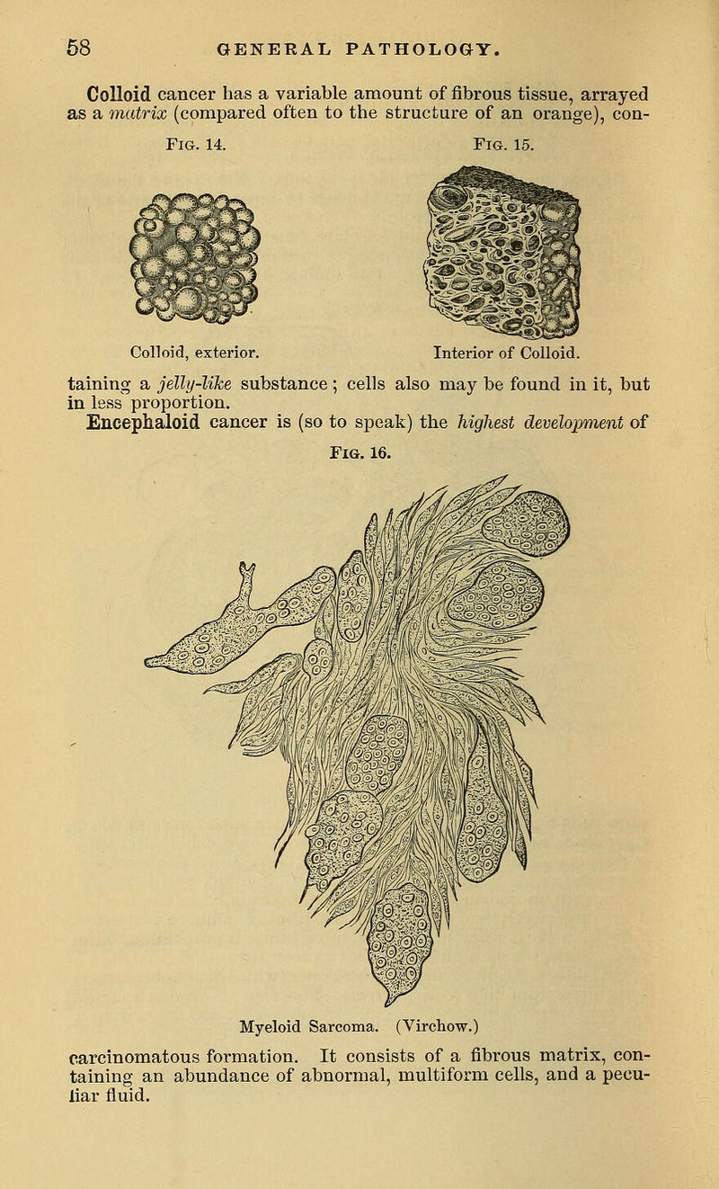 Colloid cancer has a variable amount of fibrous tissue, arrayed as a matrix (compared often to the structure of an orange), con- FlG. 14. Fig. 15. Colloid, exterior. Interior of Colloid. taining a jelly-like substance; cells also may be found in it, but in less proportion. Encephaloid cancer is (so to speak) the highest development of Fig. 16. Myeloid Sarcoma. (Virchow.) carcinomatous formation. It consists of a fibrous matrix, con- taining an abundance of abnormal, multiform cells, and a pecu- liar fluid.