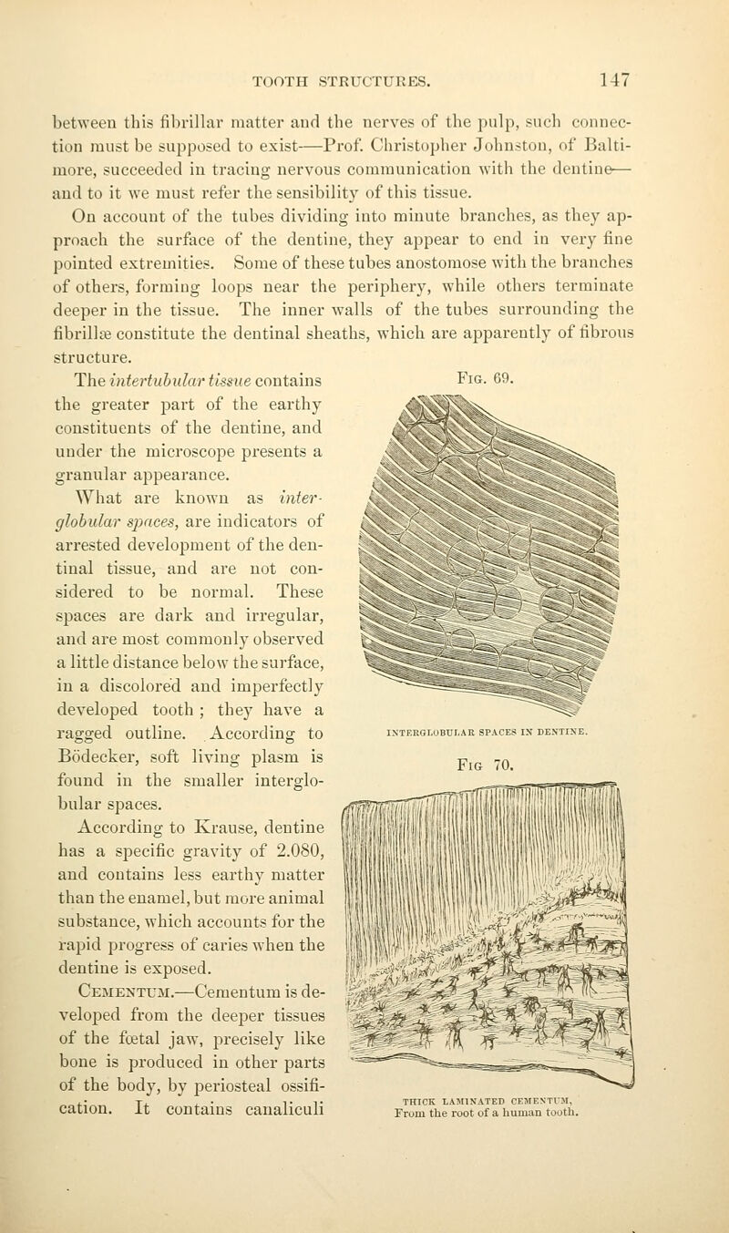 Fig. 69. between this fibrillar matter and the nerves of the pulp, such connec- tion must be supposed to exist—Prof. Christopher Johnston, of Balti- more, succeeded in tracing nervous communication with the dentine— and to it we must refer the sensibility of this tissue. On account of the tubes dividing into minute branches, as they ap- proach the surface of the dentine, they appear to end in very fine pointed extremities. Some of these tubes anostomose with the branches of others, forming loops near the periphery, while others terminate deeper in the tissue. The inner walls of the tubes surrounding the fibrill^e constitute the dentinal sheaths, which are apparently of fibrous structure. The intertuhidcvr tissue contains the greater part of the earthy constituents of the dentine, and under the microscope presents a granular appearance. What are known as inter- globular spaces, are indicators of arrested development of the den- tinal tissue, and are not con- sidered to be normal. These spaces are dark and irregular, and are most commonly observed a little distance below the surface, in a discolored and imperfectly developed tooth ; they have a ragged outline. According to Bodecker, soft living plasm is found in the smaller interglo- bular spaces. According to Krause, dentine has a specific gravity of 2.080, and contains less earthy matter than the enamel, but more animal substance, which accounts for the rapid progress of caries when the dentine is exposed. Cementum.—Cementum is de- veloped from the deeper tissues of the foetal jaw, precisely like bone is produced in other parts of the body, by periosteal ossifi- ,• Tj. ^ • ^• T THICK LAMINATED CEMENTIM, cation. it con tarns CanallCUll From the root of a human tooth. ^ ^ % IXTEnGI.OBUr.AR SPACES IN DENTINE.