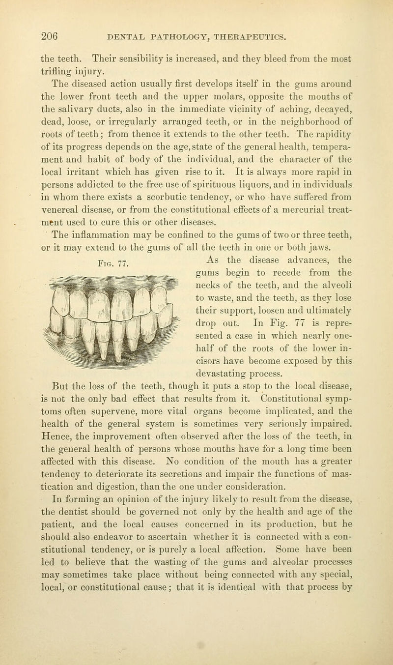 Fig. 77. the teeth. Their sensibility is increased, and they bleed from the most trifling injury. The diseased action usually first develops itself in the gums around tlie lower front teeth and the upper molars, opposite the mouths of the salivary ducts, also in the immediate vicinity of aching, decayed, dead, loose, or irregularly arranged teeth, or in the neighborhood of roots of teeth; from thence it extends to the other teeth. The rapidity of its progress depends on the age, state of the general health, tempera- ment and habit of body of the individual, and the character of the local irritant which has given rise to it. It is always more rapid in persons addicted to the free use of spirituous liquors, and in individuals in whom there exists a scorbutic tendency, or who have suflfered from venereal disease, or from the constitutional effects of a mercurial treat- ment used to cure this or other diseases. The inflammation may be confined to the gums of two or three teeth, or it may extend to the gums of all the teeth in one or both jaws. As the disease advances, the gums begin to recede from the necks of the teeth, and the alveoli to waste, and the teeth, as they lose their support, loosen and ultimately drop out. In Fig. 77 is repre- sented a case in which nearly one- half of the roots of the lower in- cisors have become exposed by this devastating process. But the loss of the teeth, though it puts a stop to the local disease, is not the only bad effect that results from it. Constitutional symp- toms often supervene, more vital organs become implicated, and the health of the general system is sometimes very seriously impaired. Hence, the improvement often observed after the loss of the teeth, in the general health of persons whose mouths have for a long time been affected with this disease. No condition of the mouth has a greater tendency to deteriorate its secretions and impair the functions of ma.s- tication and digestion, than the one under consideration. In forming an opinion of the injury likely to result from the disease, the dentist should be governed not only by the health and age of the patient, and the local causes concerned in its production, but he should also endeavor to ascertain whether it is connected with a con- stitutional tendency, or is purely a local affection. Some have been led to believe that the wasting of the gums and alveolar processes may sometimes take place without being connected with any special, local, or constitutional cause; that it is identical with that process by