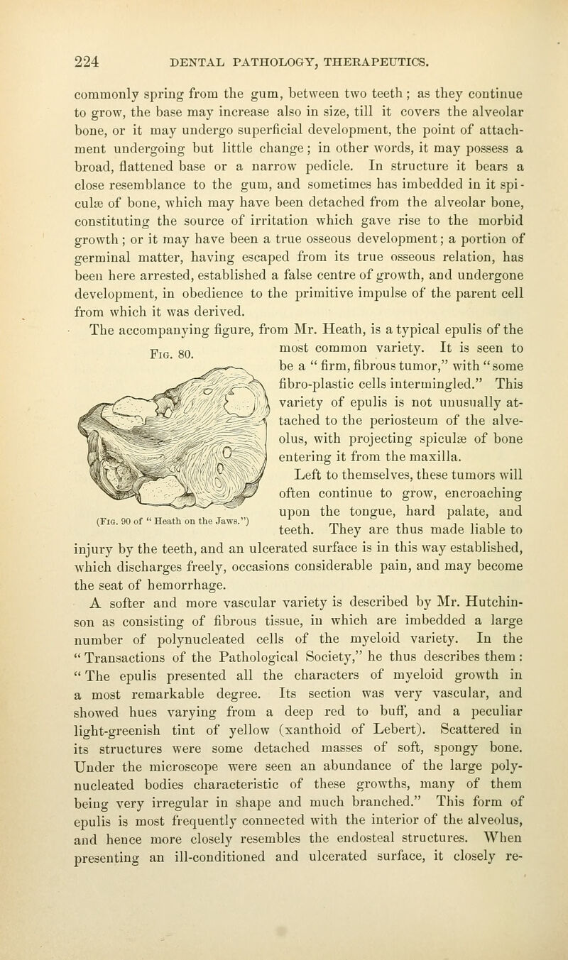 Fig. 80. commonly spring from the gum, between two teeth ; as they continue to grow, the base may increase also in size, till it covers the alveolar bone, or it may undergo superficial development, the point of attach- ment undergoing but little change; in other words, it may possess a broad, flattened base or a narrow pedicle. In structure it bears a close resemblance to the gum, and sometimes has imbedded in it spi- culse of bone, which may have been detached from the alveolar bone, constituting the source of irritation which gave rise to the morbid growth; or it may have been a true osseous development; a portion of germinal matter, having escaped from its true osseous relation, has been here arrested, established a false centre of growth, and undergone development, in obedience to the primitive impulse of the parent cell from which it was derived. The accompanying figure, from Mr. Heath, is a typical epulis of the most common variety. It is seen to be a  firm, fibrous tumor, with some fibro-plastic cells intermingled. This variety of epulis is not unusually at- tached to the periosteum of the alve- olus, with projecting spiculse of bone entering it from the maxilla. Left to themselves, these tumors will often continue to grow, encroaching upon the tongue, hard palate, and teeth. They are thus made liable to injury by the teeth, and an ulcerated surface is in this way established, which discharges freely, occasions considerable pain, and may become the seat of hemorrhage. A softer and more vascular variety is described by Mr. Hutchin- son as consisting of fibrous tissue, in which are imbedded a large number of polynucleated cells of the myeloid variety. In the  Transactions of the Pathological Society, he thus describes them:  The epulis presented all the characters of myeloid growth in a most remarkable degree. Its section was very vascular, and showed hues varying from a deep red to bufi, and a peculiar light-greenish tint of yellow (xanthoid of Lebert). Scattered in its structures were some detached masses of soft, spongy bone. Under the microscope were seen an abundance of the large poly- nucleated bodies characteristic of these growths, many of them being very irregular in shape and much branched. This form of epulis is most frequently connected with the interior of the alveolus, and heuce more closely resembles the endosteal structures. When presenting an ill-conditioned and ulcerated surface, it closely re- (FiG. 90 of  Heath on the Jaws.)