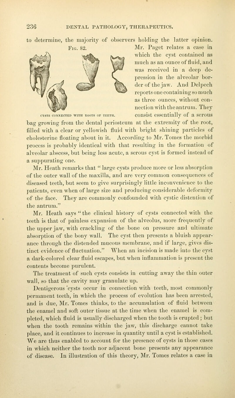 to determine, the majority of observers holding the latter opinion. Fig. 82. Mr. Paget relates a case in which the cyst contained as much as an ounce of fluid, and was received in a deep de- pression in the alveolar bor- der of the jaw. And Delpech reports one containing so m uch as three ounces, without con- nection with the antrum. They cTSTs coNKECTED WITH ROOTS OF TEETH. coHslst cssentially of a scrous bag growing from the dental periosteum at the extremity of the root, filled with a clear or yellowish fluid with bright shining particles of cholesterine floating about in it. According to Mr. Tomes the morbid process is probably identical with that resulting in the formation of alveolar abscess, but being less acute, a serous cyst is formed instead of a suppurating one. Mr. Heath remarks that  large cysts produce more or less absorption of the outer wall of the maxilla, and are very common consequences of diseased teeth, but seem to give surprisingly little inconvenience to the patients, even when of large size and producing considerable deformity of the face. They are commonly confounded with cystic distention of the antrum. Mr. Heath says  the clinical history of cysts connected with the teeth is that of painless expansion of the alveolus, more frequently of the upper jaw, with crackling of the bone on pressure and ultimate absorption of the bony wall. The cyst then presents a bluish appear- ance through the distended mucous membrane, and if large, gives dis- tinct evidence of fluctuation. When an incision is made into the cyst a dark-colored clear fluid escapes, but when inflammation is present the contents become purulent. The treatment of such cysts consists in cutting away the thin outer wall, so that the cavity may granulate up. Dentigerous 'cysts occur in connection with teeth, most commonly permanent teeth, in which the process of evolution has been arrested, and is due, Mr. Tomes thinks, to the accumulation of fluid between the enamel and soft outer tissue at the time when the enamel is com- pleted, which fluid is usually discharged when the tooth is erupted ; but when the tooth remains within the jaw, this discharge cannot take place, and it continues to increase in quantity until a cyst is established. We are thus enabled to account for the presence of cysts in those cases in which neither the tooth nor adjacent bone presents any appearance of disease. In illustration of this theory, Mr. Tomes relates a case in