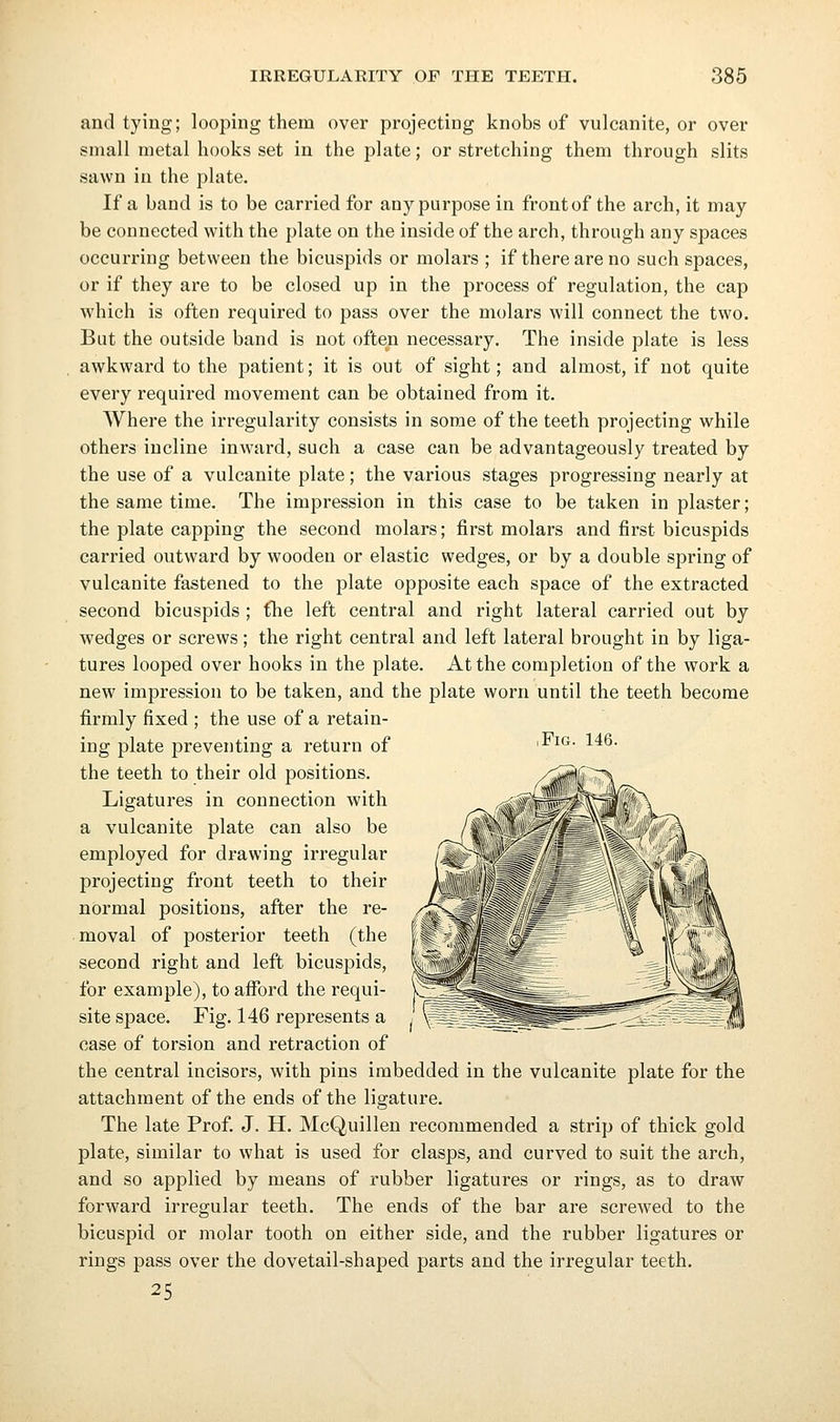 and tying; looping them over projecting knobs of vulcanite, or over small metal hooks set in the plate; or stretching them through slits sawn in the plate. If a band is to be carried for any purpose in frontof the arch, it may be connected with the plate on the inside of the arch, through any spaces occurring between the bicuspids or molars ; if there are no such spaces, or if they ai-e to be closed up in the process of regulation, the cap which is often required to pass over the molars will connect the two. But the outside band is not often necessary. The inside plate is less awkwai'd to the patient; it is out of sight; and almost, if not quite every required movement can be obtained from it. Where the irregularity consists in some of the teeth projecting while others incline inward, such a case can be advantageously treated by the use of a vulcanite plate; the various stages progressing nearly at the same time. The impression in this case to be taken in plaster; the plate capping the second molars; first molars and first bicuspids carried outward by wooden or elastic wedges, or by a double spring of vulcanite fastened to the plate opposite each space of the extracted second bicuspids ; £he left central and right lateral carried out by wedges or screws; the right central and left lateral brought in by liga- tures looped over hooks in the plate. At the completion of the work a new impression to be taken, and the plate worn until the teeth become firmly fixed ; the use of a retain- ing plate preventing a return of the teeth to their old positions. Ligatures in connection with a vulcanite plate can also be employed for drawing irregular projecting front teeth to their normal positions, after the re- moval of posterior teeth (the second right and left bicuspids, for example), to afford the requi- site space. Fig. 146 represents a case of torsion and retraction of the central incisors, with pins imbedded in the vulcanite plate for the attachment of the ends of the ligature. The late Prof. J. H. McQuillen recommended a strip of thick gold plate, similar to what is used for clasps, and curved to suit the arch, and so applied by means of rubber ligatures or rings, as to draw forward irregular teeth. The ends of the bar are screwed to the bicuspid or molar tooth on either side, and the rubber ligatures or rings pass over the dovetail-shaped parts and the irregular teeth. 25