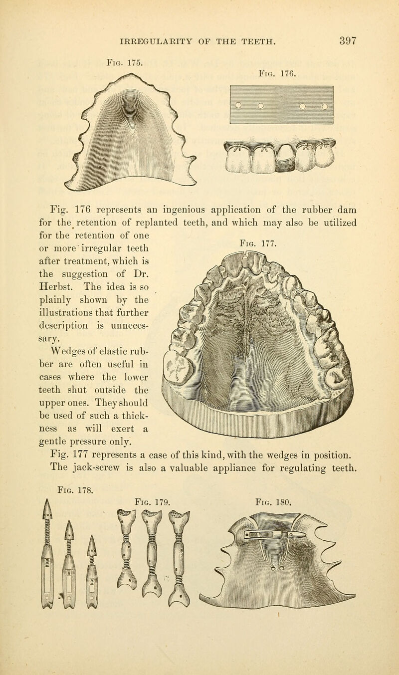 Fig. 175. Fio. 176. ■ Fig. 177. Fig. 176 represents an ingenious application of the rubber dam for the_ retention of replanted teeth, and which may also be utilized for the retention of one or more'irregular teeth after treatment, which is the suggestion of Dr. Herbst. The idea is so plainly shown by the illustrations that further description is unneces- sary. Wedges of elastic rub- ber are often useful in cases where the lower teeth shut outside the upper ones. They should be used of such a thick- ness as will exert a gentle pressure only. Fig. 177 represents a case of this kind, with the wedges in position. The jack-screw is also a valuable appliance for regulating teeth. Fig. 178.