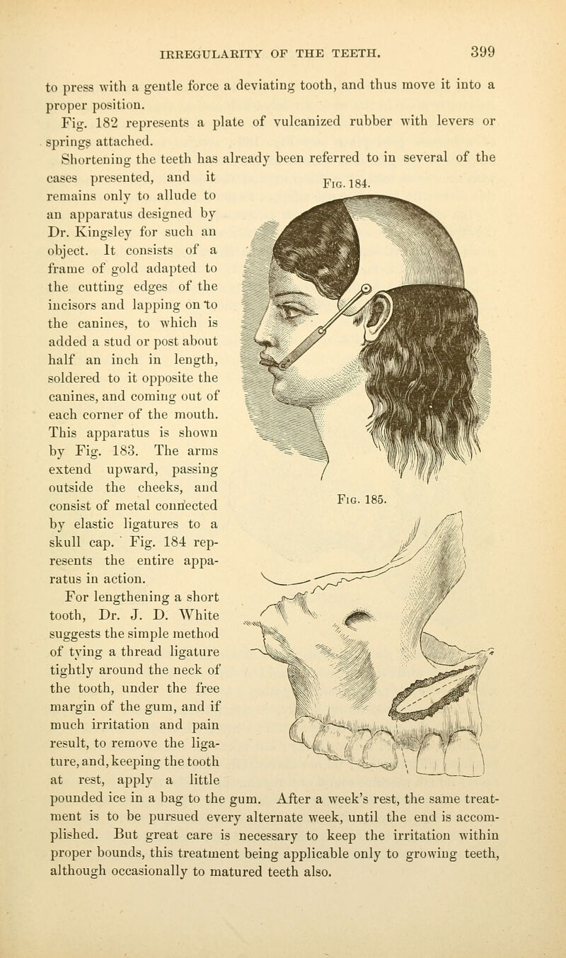 Fig.184. to press with a geutle force a deviating tooth, and thus move it into a proper position. Fig, 182 represents a plate of vulcanized rubber with levers or springs attached. Shortening the teeth has already been referred to in several of the cases presented, and it remains only to allude to an apparatus designed by Dr. Kingsley for such an object. It consists of a frame of gold adapted to the cutting edges of the incisors and lapping on to the canines, to which is added a stud or post about half an inch in length, soldered to it opposite the canines, and coming out of each corner of the mouth. This apparatus is shown by Fig. 183. The arms extend upward, passing outside the cheeks, and consist of metal connected by elastic ligatures to a skull cap. ' Fig. 184 rep- resents the entire appa- ratus in action. For lengthening a short tooth. Dr. J. D. White suggests the simple method of tying a thread ligature tightly around the neck of the tooth, under the free margin of the gum, and if much irritation and pain result, to remove the liga- ture, and, keeping the tooth at rest, apply a little pounded ice in a bag to the gum. After a week's rest, the same treat- ment is to be pursued every alternate week, until the end is accom- plished. But great care is necessary to keep the irritation within proper bounds, this treatment being applicable only to growing teeth, although occasionally to matured teeth also.