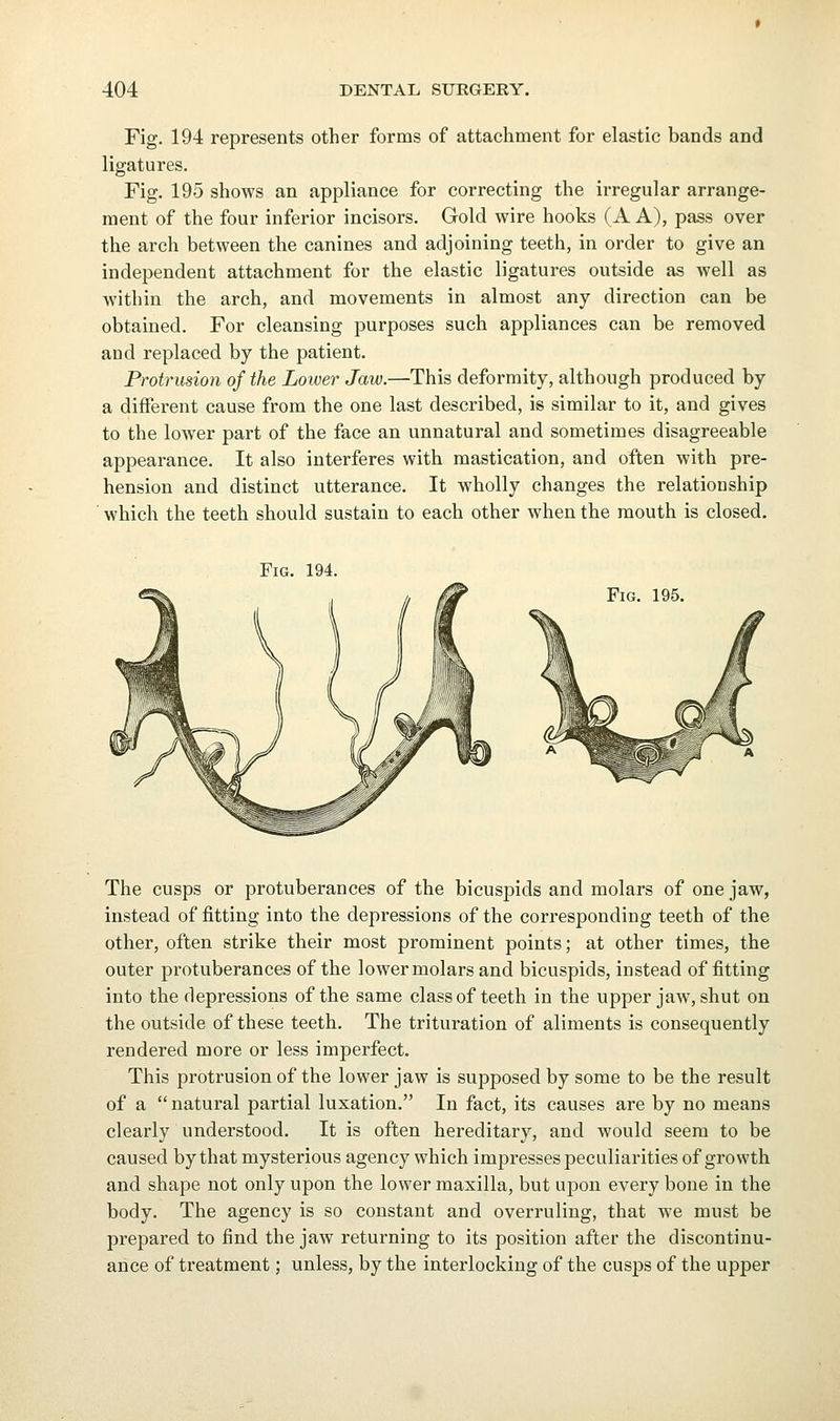 Fig. 194 represents other forms of attachment for elastic bands and ligatures. Fig. 195 shows an appliance for correcting the irregular arrange- ment of the four inferior incisors. Gold wire hooks (A A), pass over the arch between the canines and adjoining teeth, in order to give an independent attachment for the elastic ligatures outside as well as within the arch, and movements in almost any direction can be obtained. For cleansing purposes such appliances can be removed and replaced by the patient. Protrusion of the Lower Jaw.—This deformity, although produced by a different cause from the one last described, is similar to it, and gives to the lower part of the face an unnatural and sometimes disagreeable appearance. It also interferes with mastication, and often with pre- hension and distinct utterance. It wholly changes the relationship which the teeth should sustain to each other when the mouth is closed. Fig. 194. Fig. 195. The cusps or protuberances of the bicusjDids and molars of one jaw, instead of fitting into the depressions of the corresponding teeth of the other, often strike their most prominent points; at other times, the outer protuberances of the lower molars and bicuspids, instead of fitting into the depressions of the same class of teeth in the upper jaw, shut on the outside of these teeth. The trituration of aliments is consequently rendered more or less imperfect. This protrusion of the lower jaw is supposed by some to be the result of a  natural partial luxation. In fact, its causes are by no means clearly understood. It is often hereditary, and would seem to be caused by that mysterious agency which impi'esses peculiarities of growth and shape not only upon the lower maxilla, but upon every bone in the body. The agency is so constant and overruling, that we must be prepared to find the jaw returning to its position after the discontinu- ance of treatment; unless, by the interlocking of the cusps of the upper