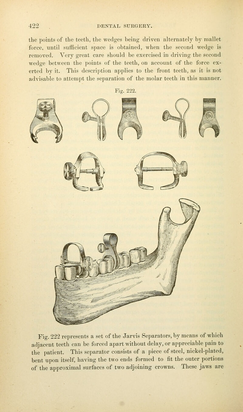 the points of the teeth, the wedges heing driven alternately by mallet force, until sufficient space is obtained, when the second wedge is removed. Very great care should be exercised in driving the second wedge between the points of the teeth, on account of the force ex- erted by it. This description applies to the front teeth, as it is not advisable to attempt the separation of the molar teeth in this manner. Fig. 222. Fig. 222 represents a set of the Jarvis Separators, by means of which adjacent teeth can be forced apart without delay, or appreciable pain to the patient. This separator consists of a piece of steel, nickel-plated, bent upon itself, having the two ends formed to fit the outer portions of the approximal surfaces of two adjoining crowns. These jaws are