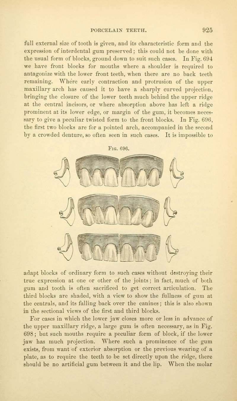 full external size of tooth is given, and its characteristic form and the expression of interdental gum preserved; this could not be done with the usual form of blocks, ground down to suit such cases. In Fig. 694 we have front blocks for mouths where a shoulder is required to antagonize with the lower front teeth, when there are no back teeth remaining. Where early contraction and protrusion of the upper maxillary arch has caused it to have a sharply curved projection, bringing the closure of the lower teeth much behind the upper ridge at the central incisors, or where absorption above has left a ridge prominent at its lower edge, or margin of the gum, it becomes neces- sary to give a peculiar twisted form to the front blocks. In Fig. 696. the first two blocks are for a pointed arch, accompauied in the second by a crowded denture, so often seen in such cases. It is impossible to Fig. 696. adapt blocks of ordinary form to such cases without destroying their true expression at one or other of the joints ; in fact, much of both gum and tooth is often sacrificed to get correct articulation. The third blocks are shaded, with a view to show the fullness of gum at the centrals, and its falling back over the canines; this is also shown in the sectional views of the first and third blocks. For cases in which the lower jaw closes more or less in advance of the upper maxillary ridge, a large gum is often necessary, as in Fig. 698; but such mouths require a peculiar form of block, if the lower jaw has much projection. Where such a prominence of the gum exists, from want of exterior absorption or the previous wearing of a plate, as to require the teeth to be set directly upon the ridge, there should be no artificial gum between it and the lip. When the molar