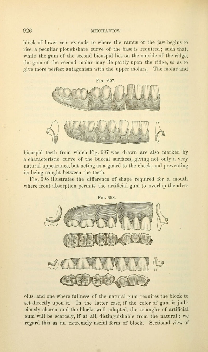 block of lower sets extends to where the ramus of the jaw begins to rise, a peculiar ploughshare curve of the base is required; such that, while the gum of the second bicuspid lies on the outside of the ridge, the gum of the second molar may lie partly upon the ridge, so as to give more perfect antagonism with the upper molars. The molar and Fig. 697. bicuspid teeth from which Fig. 697 was drawn are also marked by a characteristic curve of the buccal surfaces, giving not only a very natural appearance, but acting as a guard to the cheek, and preventing its being caught between the teeth. Fig. 698 illustrates the difference of shape required for a mouth where front absorption permits the artificial gum to overlap the alve- FiG. 698. olus, and one where fullness of the natural gum requires the block to set directly upon it. In the latter case, if the color of gum is judi- ciously chosen and the blocks well adapted, the triangles of artificial gum will be scarcely, if at all, distinguishable from the natural; we regard this as an extremely useful form of block. Sectional view of