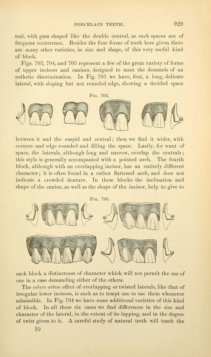 tral, with gum shaped like the double central, as such spaces are of frequent occurrence. Besides the four forms of teeth here given there are many other varieties, in size and shape, of this very useful kind of block. Figs. 703, 704, and 705 represent a few of the great variety of forms of upper incisors and canines, designed to meet the demands of an aesthetic discrimination. In Fig. 703 we have, first, a long, delicate lateral, with sloping but not rounded edge, showing a decided space Fig. 702. between it and the cuspid and central; then we find it wider, Avith corners and edge rounded and filling the space. Lastly, for want of space, the laterals, although long and narrow, overlap the centrals; this style is generally accompanied with a pointed arch. The fourth block, although with an overlapping incisor, has an entirely different character; it is often found in a rather flattened arch, and does not indicate a crowded denture. In these blocks the inclination and shape of the canine, as well as the shape of the incisor, help to give to Fig. 703. each block a distinctness of character which will not permit the use of one in a case demanding either of the others. The celare artevi effect of overlapping or twisted laterals, like that of irregular lower incisors, is such as to tempt one to use them whenever admissible. In Fig. 704 we have some additional varieties of this kind of block. In all these six cases we find differences in the size and character of the lateral, in the extent of its lapping, and in the degree of twist given to it. A careful study of natural teeth will teach the 59