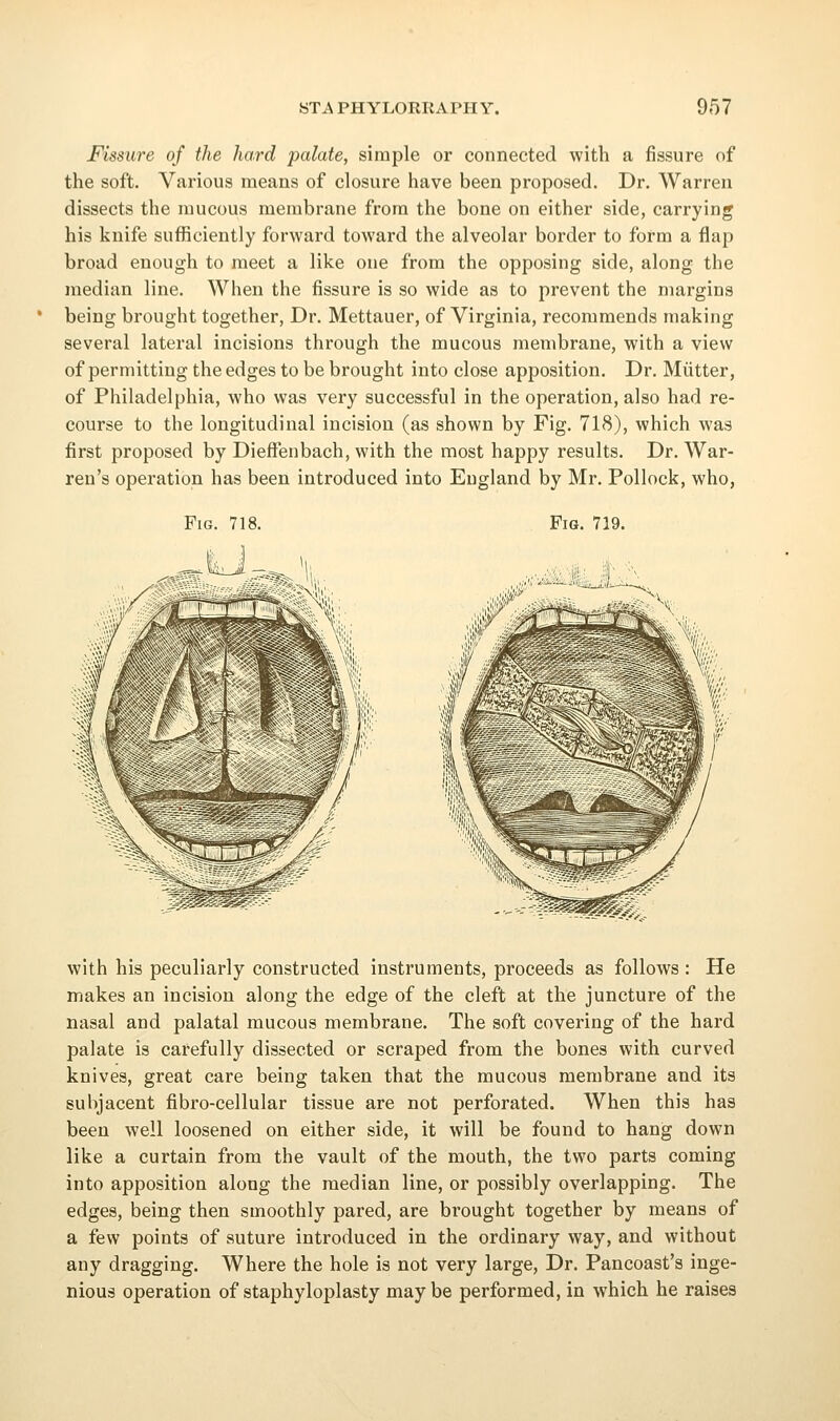Fissure of the hard palate, simple or connected with a fissure of the soft. Various means of closure have been proposed. Dr. Warren dissects the mucous membrane from the bone on either side, carrying his knife sufficiently forward toward the alveolar border to form a flap broad enough to meet a like one from the opposing side, along the median line. When the fissure is so wide as to prevent the margins being brought together, Dr. Mettauer, of Virginia, recommends making several lateral incisions through the mucous membrane, with a view of permitting the edges to be brought into close apposition. Dr. Mutter, of Philadelphia, who was very successful in the operation, also had re- course to the longitudinal incision (as shown by Fig. 718), which was first proposed by Dieffenbach, with the most happy results. Dr. War- ren's operation has been introduced into England by Mr. Pollock, who, Fig. 718. Fig. 719. with his peculiarly constructed instruments, proceeds as follows : He makes an incision along the edge of the cleft at the juncture of the nasal and palatal mucous membrane. The soft covering of the hard palate is carefully dissected or scraped from the bones with curved knives, great care being taken that the mucous membrane and its subjacent fibro-cellular tissue are not perforated. When this has been well loosened on either side, it will be found to hang down like a curtain from the vault of the mouth, the two parts coming into apposition along the median line, or possibly overlapping. The edges, being then smoothly pared, are brought together by means of a few points of suture introduced in the ordinary way, and without any dragging. Where the hole is not very large. Dr. Pancoast's inge- nious operation of staphyloplasty maybe performed, in which he raises